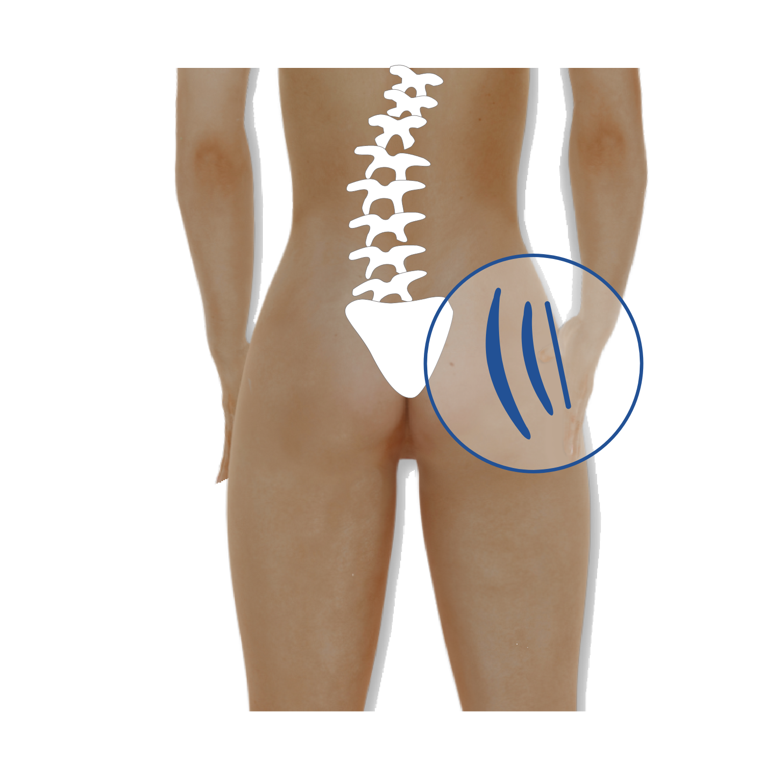 Grafika przedstawiająca umiejscowienie peloty przy odcinku krzyżowym kręgosłupa.
