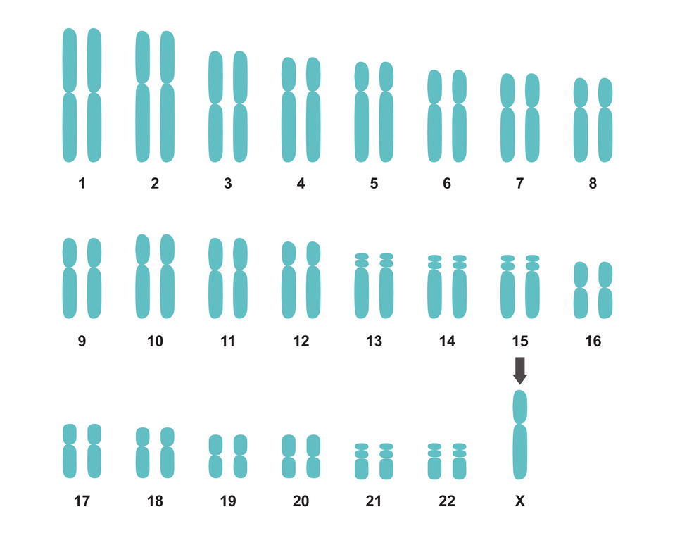 Ilustracja przedstawia kariotyp osoby z zespołem Turnera. Na ilustracji 22 pary chromosomów różnej wielkości. W ostatniej, 23 parze prawidłowo powinny występować chromosomy XX (żeńskie) oraz XY (żeński i męski), które warunkują płeć. W tym przypadku występuje tylko jeden chromosom X. 
