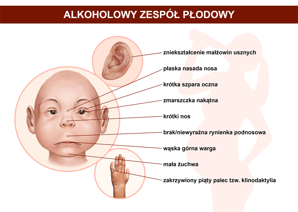 Ilustracja przedstawia twarz dziecka. Zaznaczono na niej cechy wyglądu, na które wpływ ma alkohol. Należą do nich: zniekształcenie małżowin usznych, płaska nasada nosa, krótka szpara oczna, zmarszczka nakątna (znajduje się w górnej części nosa), krótki nos, brak lub niewyraźna rynienka nosowa (znajduje się między nosem a ustami), wąska górna warga, mała żuchwa, zakrzywiony piąty palec w dłoni tak zwana klinodaktylia. 