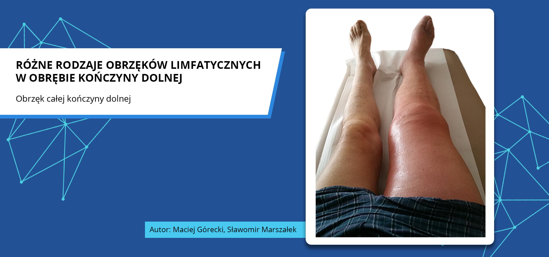 Zdjęcie o tytule różne rodzaje obrzęków limfatycznych w obrębie kończyny dolnej. Obrzęk całej kończyny dolnej. Zdjęcie przedstawia kończyny dolne pacjenta leżącego na kozetce lekarskiej. Prawa kończyna dolna jest na całej długości opuchnięta i zaczerwieniona.
Autorzy zdjęcia: Maciej Górecki, Sławomir Marszałek.