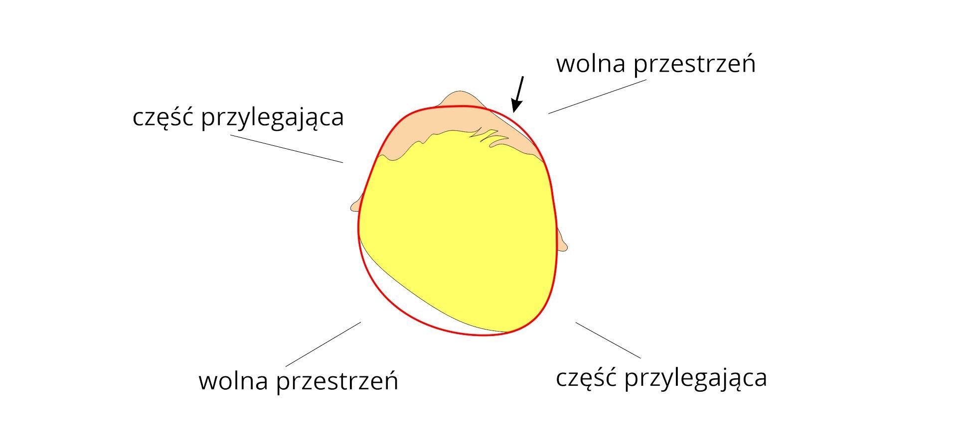 Grafika przedstawia, w widoku z góry, ludzką głowę z asymetrycznym, skośnym wybrzuszeniem tyłu czaszki po prawej stronie. Czoło wybrzuszone jest po prawej stronie. Po prawej stronie ucho jest wysunięte do przodu. Na grafice zaznaczono prawidłowy kształt głowy oraz części przylegające po prawej stronie tyłu czaszki i po lewej stronie czoła. Wolne przestrzenie zaznaczono na lewej stronie tyłu czaszki i prawej stronie czoła.
