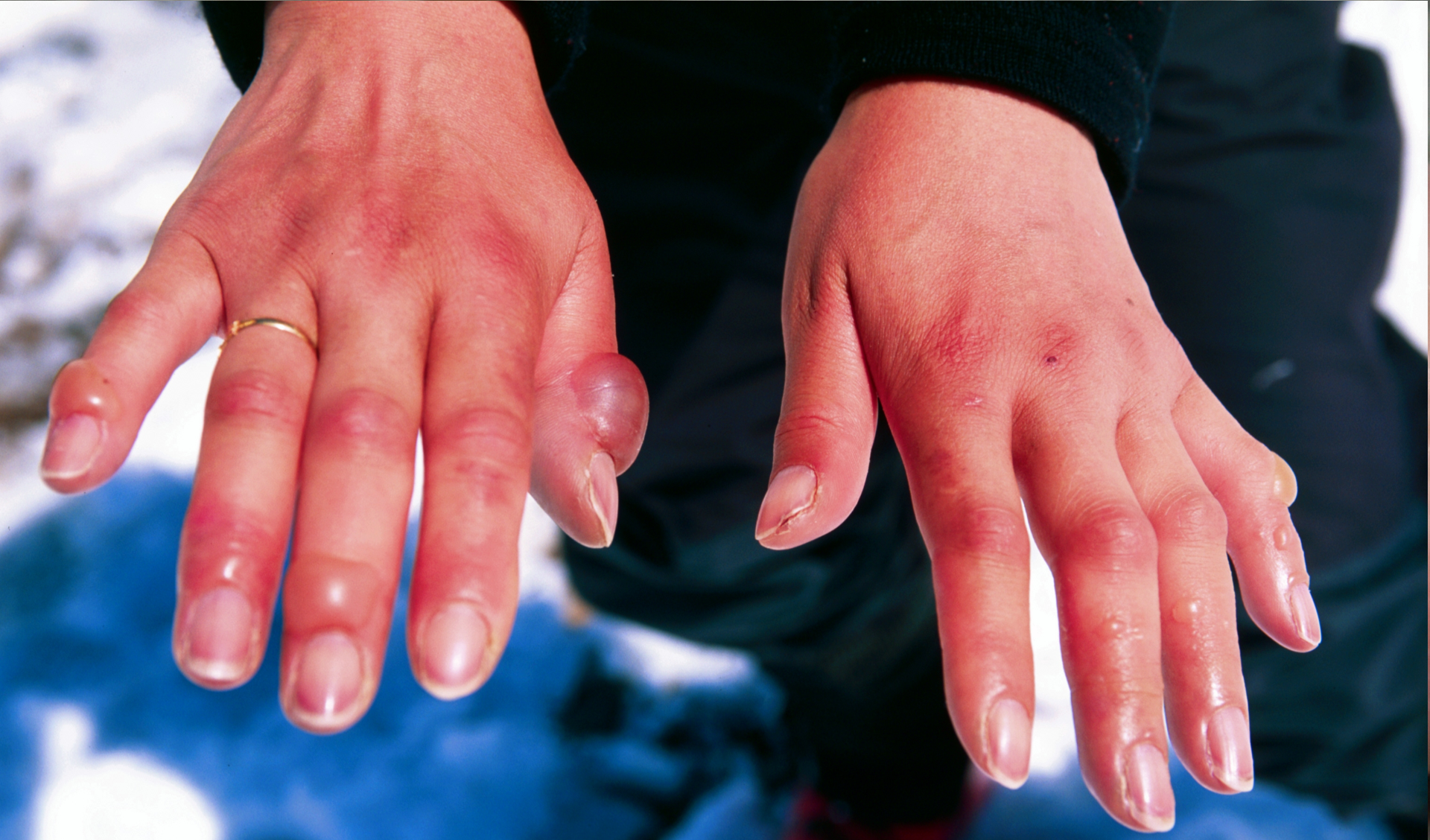 Fotografia poparzonych kobiecych dłoni, na których widoczne są bąble. Kobieta ma na dłoniach obrączkę , zadbane krótkie paznokcie. Na lewej dłoni bąble są duże, największy na kciuku, mniejsze na małym palcu oraz palcu serdecznym. Na prawej dłoni bąble są mniejsze i drobne znajdują się na palcach.