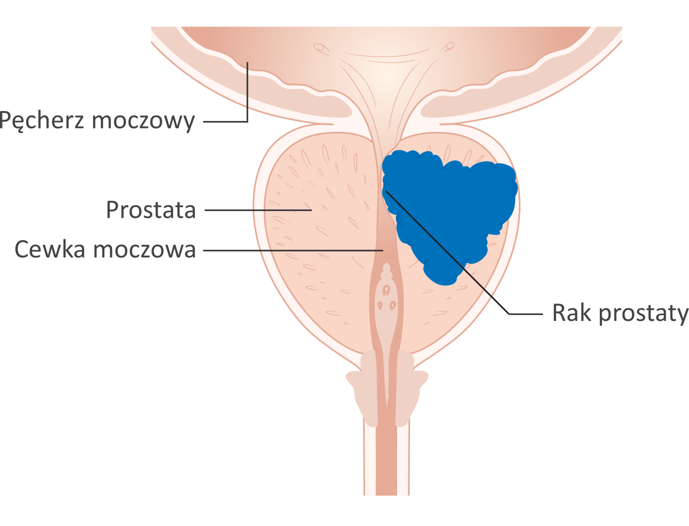 Ilustracja przedstawia różowy, męski układ płciowy na szarym tle. W kształcie półkola, na samej górze przedstawiony jest pęcherz moczowy, od niego, poniżej, odchodzi prostata w kształcie serca, przez której środek przechodzi podłużna, wąska cewka moczowa. W prawej części prostaty widnieje niebieski, o nieregularnym kształcie, rak prostaty.