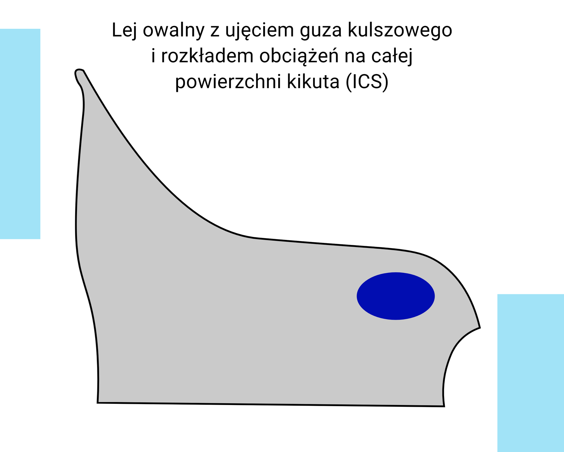 Schemat graficzny przedstawiający przekrój czołowy leja owalnego z ujęciem guza kulszowego i rozkładem obciążeń na całej powierzchni kikuta (ICS).