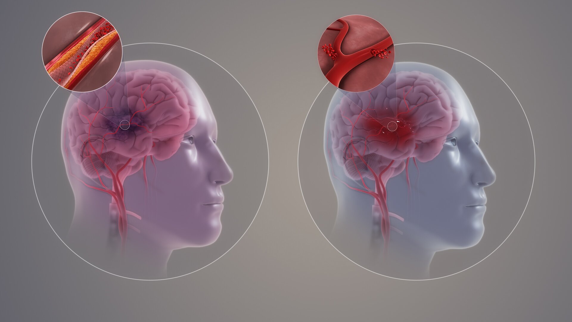 Na ilustracji są dwie ludzkie głowy z narysowanym mózgiem. Przy mózgu jest zbliżenie na fragment naczynia krwionośnego. Na obrazku po lewej stronie naczynie krwionośne jest zwężone w jednym miejscu, ale krew przepływa przez to miejsce. W mózgu człowieka jest obszar zaznaczony kolorem fioletowym. Na obrazku po prawej stronie naczynia są wąskie. W niektórych miejscach krew wydostaje się z naczyń. W mózgu osoby zaznaczono czerwona plamę - przedstawia ona miejsce udaru.     