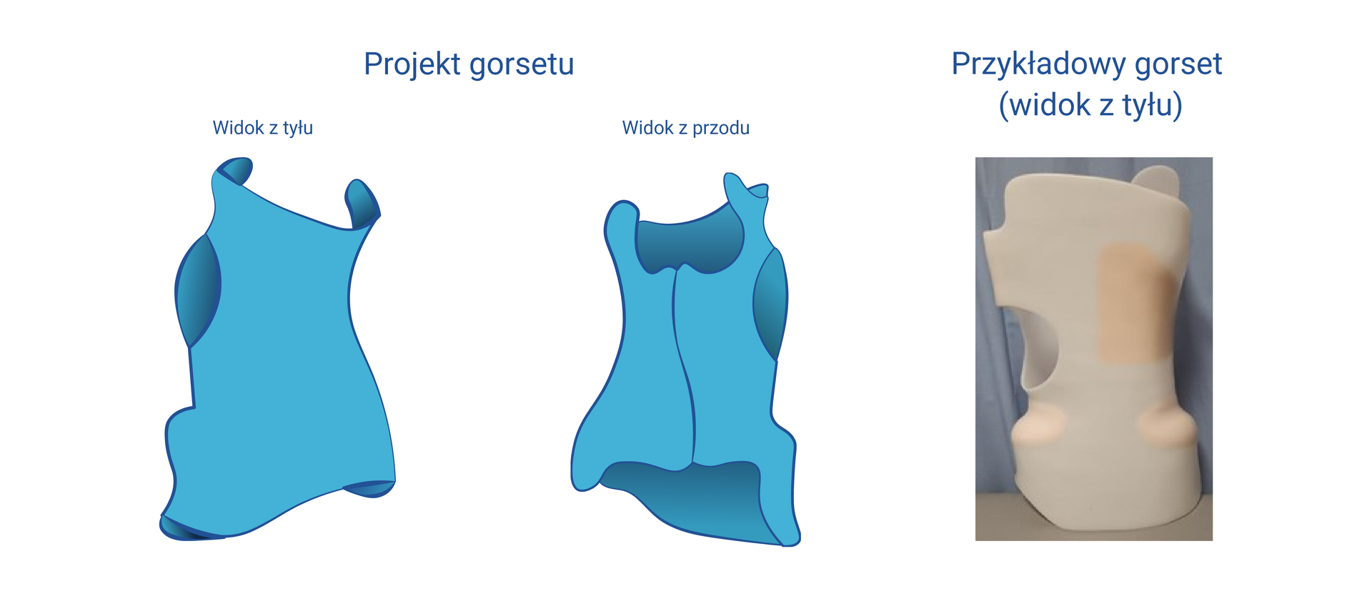 Grafika przedstawiająca schemat gorsetu z przodu i z tyłu. Gorset obejmuje większość tułowia. Na rycinie zamieszczono również zdjęcie przykładowego gorsetu z tworzywa sztucznego w widoku z tyłu.
