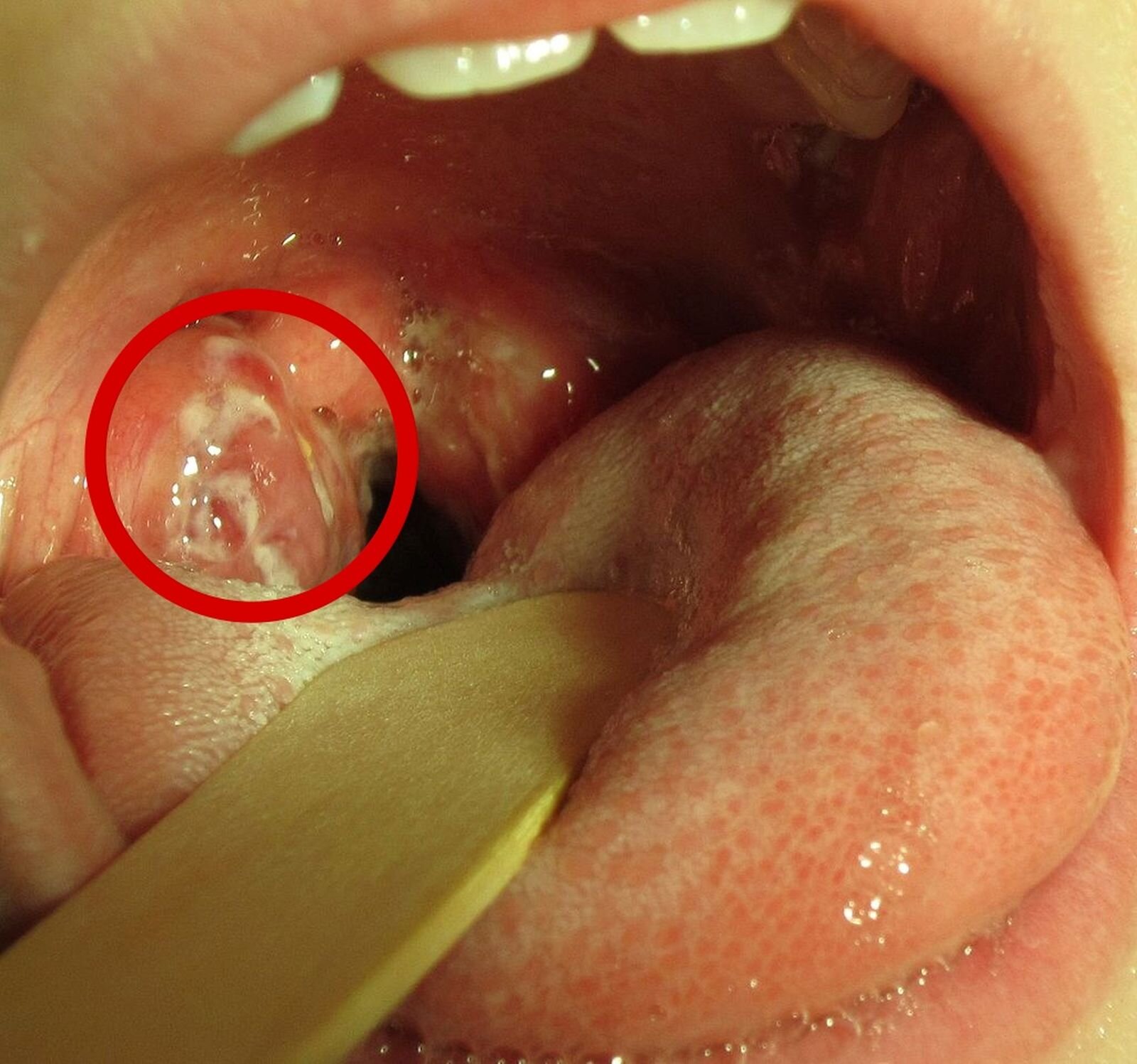 Zdjęcie przedstawia rozchylone usta, widoczne są zainfekowane migdałki, pokryte białożółtym nalotem.