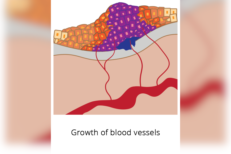 Ilustracja przedstawia guz z naczyniami włosowatymi. Podpisano: Growth of blood vessels