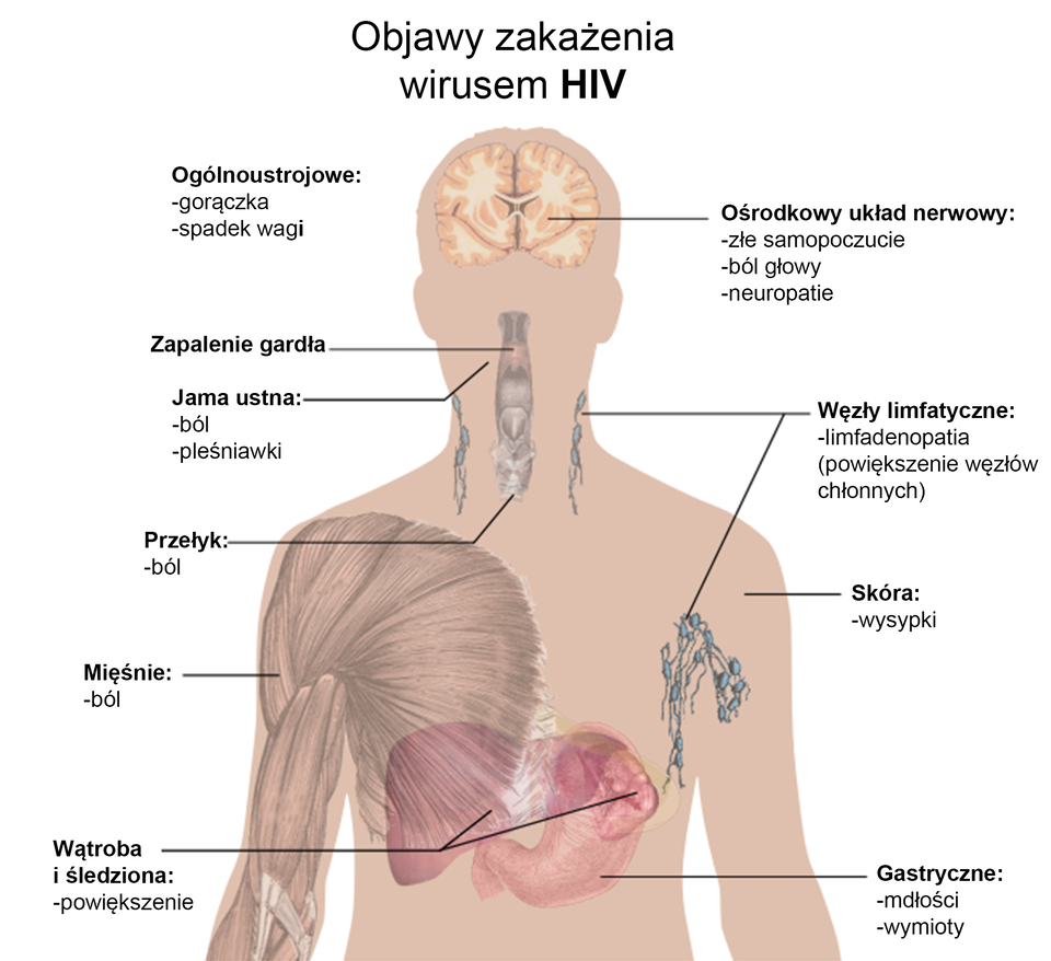 Ilustracja przedstawia postać człowieka od pasa w górę. Zaznaczone są na niej organy oraz główne objawy zakażenia wirusem HIV. Nad rysunkiem widnieje napis: objawy ogólnoustrojowe - gorączka, spadek wagi. Poczynając od góry na schemacie zaznaczony jest mózg z napisem: ośrodkowy układ nerwowy - złe samopoczucie, ból głowy, neuropatia. Na szyi zaznaczony jest przełyk z napisem: zapalenie gardła, jama ustna – ból, pleśniawki oraz przełyk – ból. Z boku szyi oraz pod pachami zaznaczone są węzły limfatyczne z napisem: adenopatia (powiększenie węzłów chłonnych). Na ręce oznaczono mięśnie. Objawem zakażenia z ich strony jest ból, a ze strony wątroby, śledziony i żołądka powiększenie tych organów. Objawy gastryczne to mdłości i wymioty. Na schemacie zaznaczona jest również skóra, a objawem zakażenia wirusem HIV z jej strony są wysypki. 