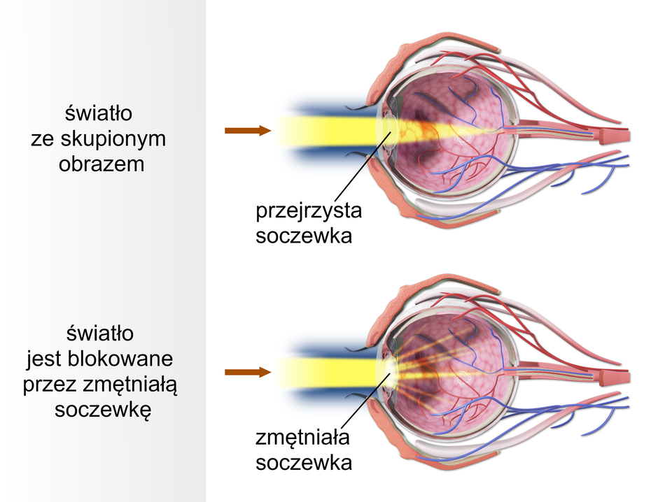 Ilustracja przedstawia obraz anatomiczny okaz z przejrzystą soczewką, w której przedstawiono światło ze skupionym obrazem. Promienie świetlne dostają się do siatkówki. Przy chorej, zmętniałej soczewce, światło jest przez nią blokowane i rozprasza się za soczewką w postaci promieni. 