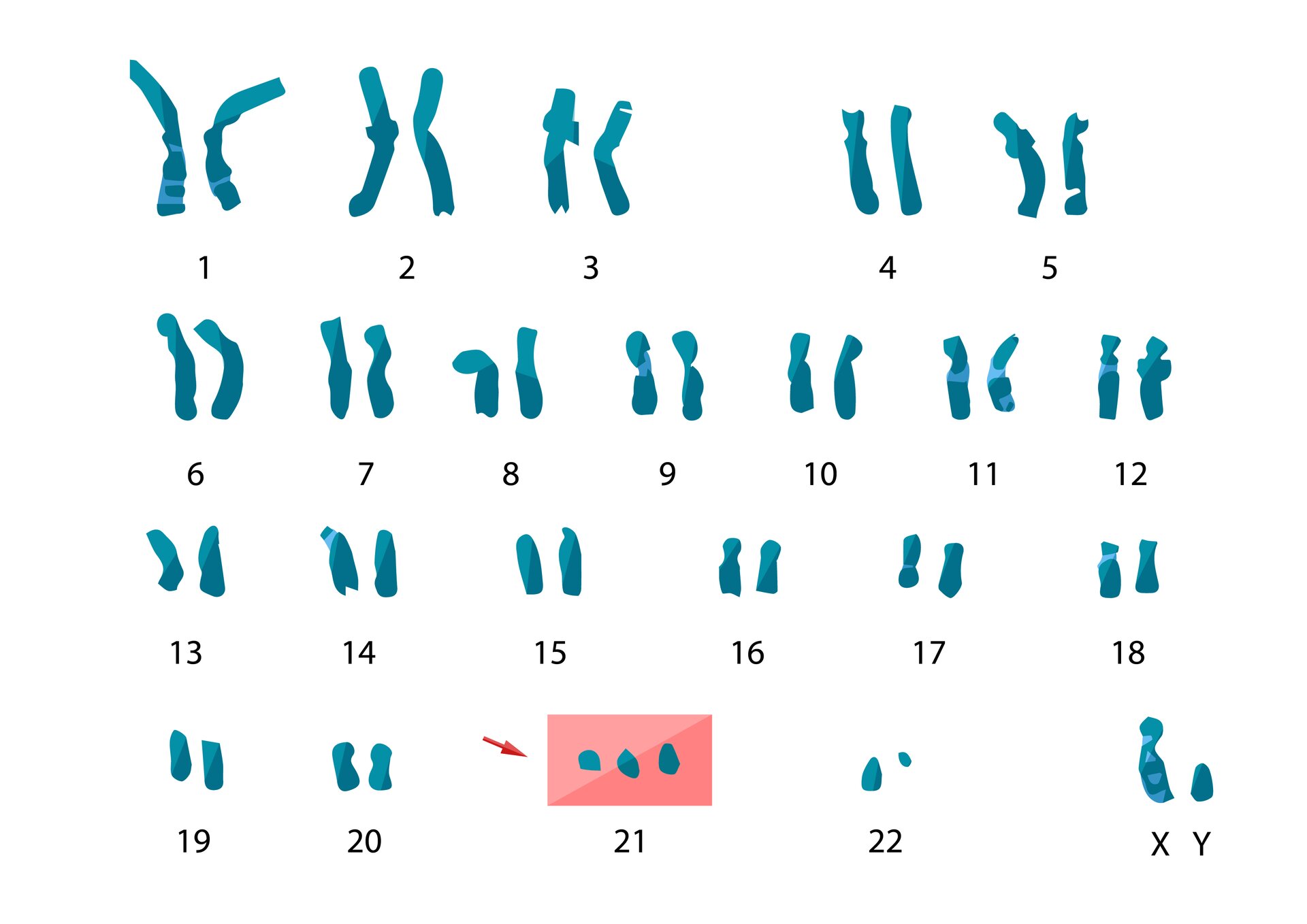 Ilustracja ukazuje 23 pary chromosomów. Przy 21. parze jest dodatkowy, trzeci chromosom. Największa jest para chromosomów pierwsza i druga, najmniejsza 22. 23 para chromosomów to XY.  X jest większe od Y. 