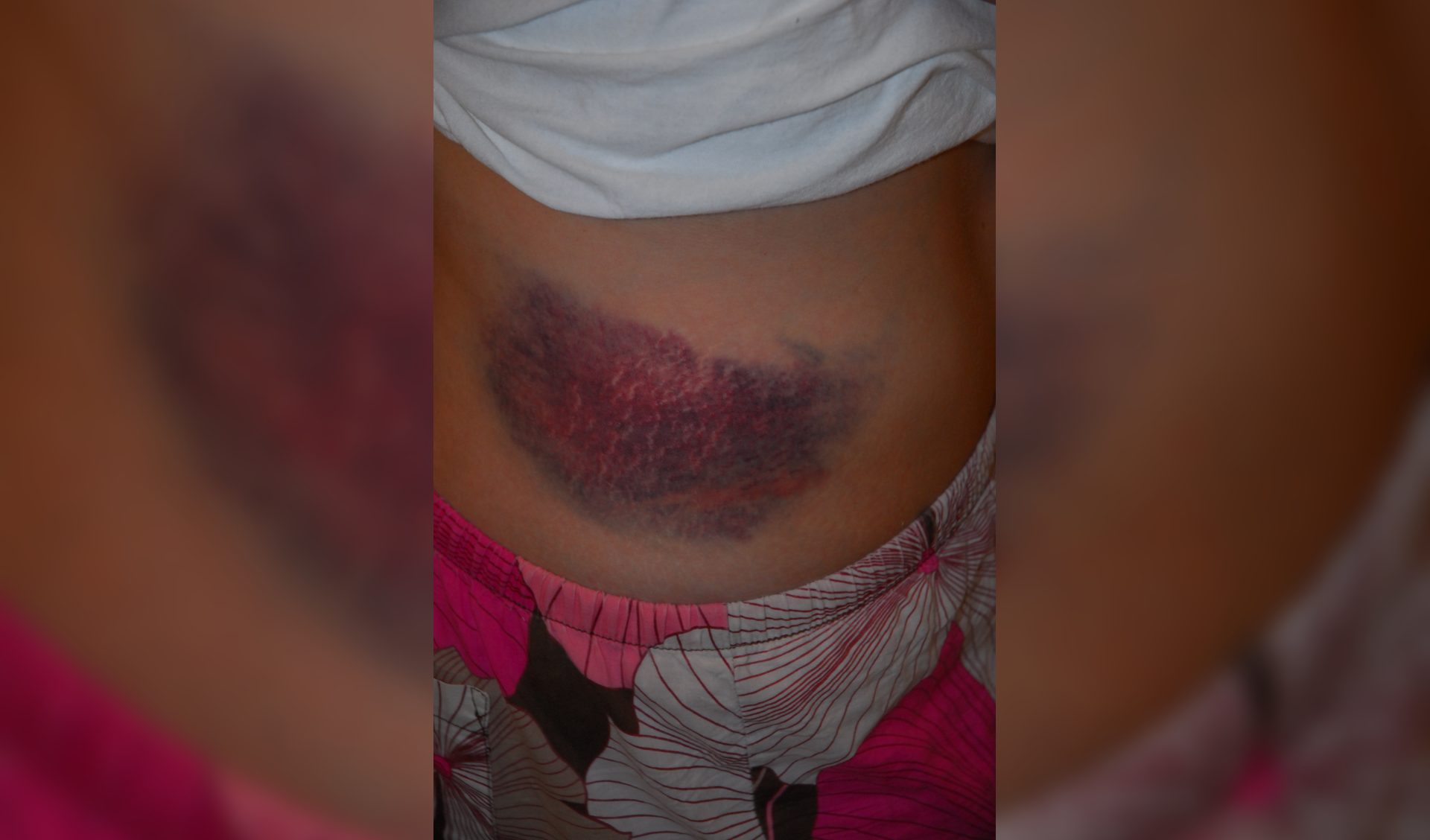 Fotografia stłuczenia. Ilustracja przedstawia duży siniak na boku tułowia.