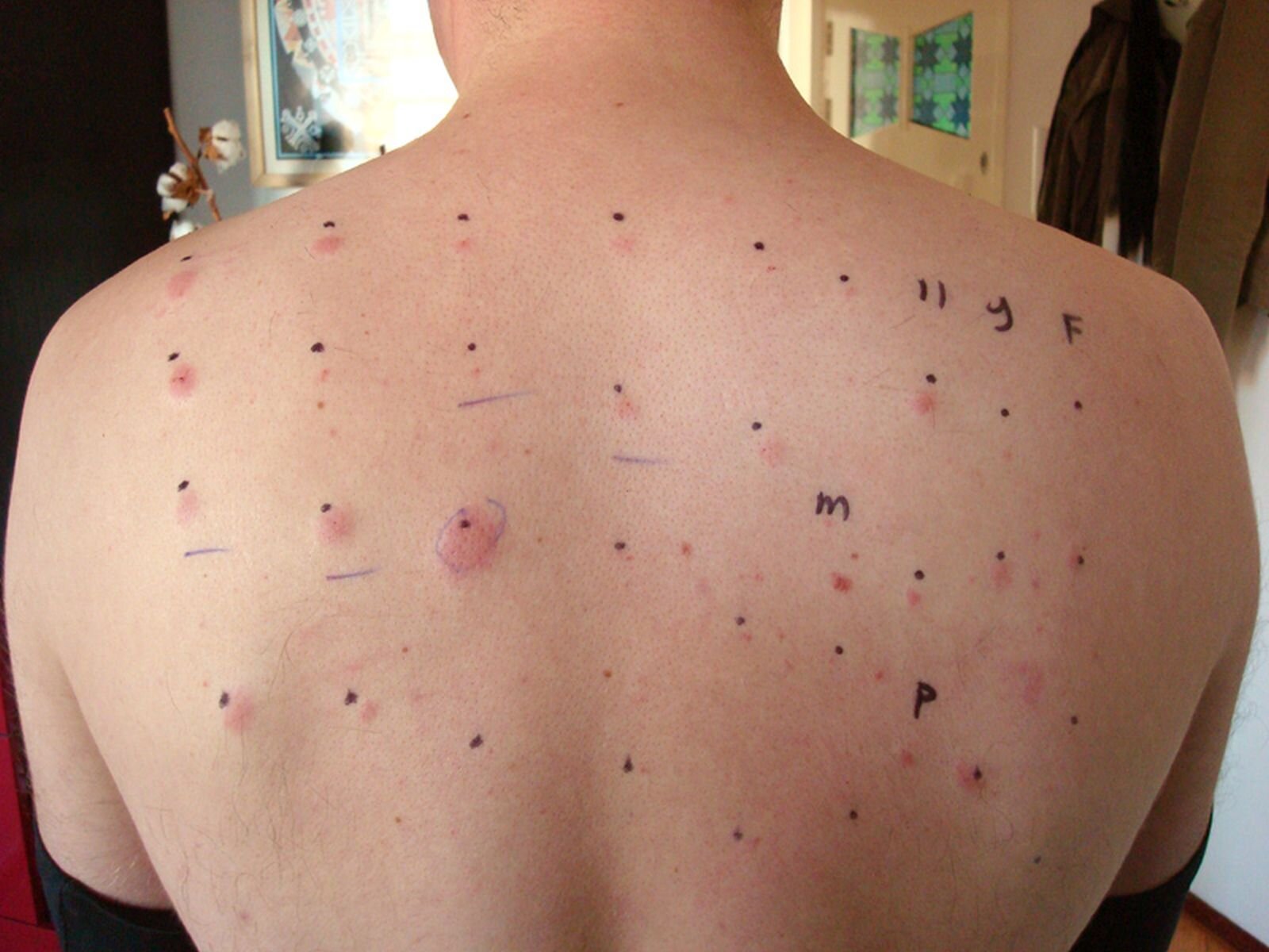 Na planszy widoczne są szerokie, jasne plecy dziecka, na których długopisem, zaznaczone są w kilku rzędach, niebieskie, równe kropki oraz pojedyncze litery. Przy niektórych kropkach widoczna jest spuchnięta, zaczerwieniona skóra.