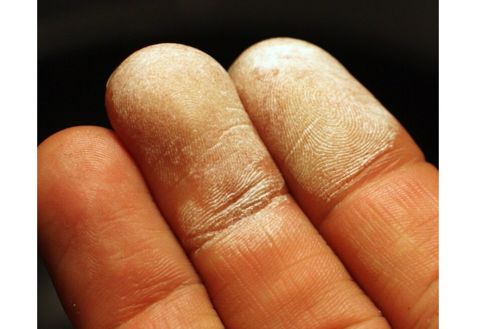 Na zdjęciu widoczne trzy palce. Opuszki dwóch z nich są pokryte białym nalotem.