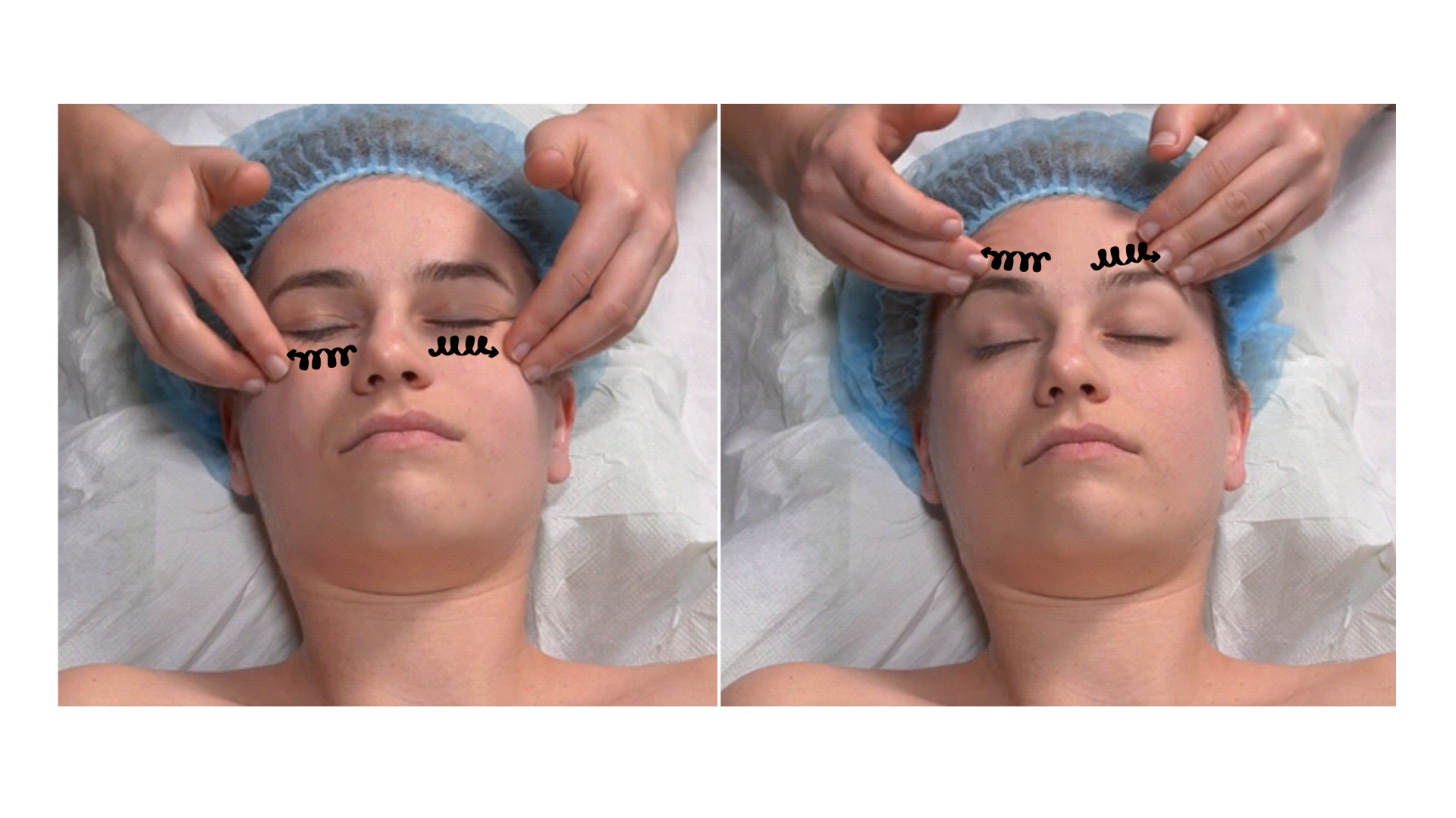 Zdjęcie przedstawia twarz pacjenta w leżeniu tyłem. Głowa pacjenta spoczywa na poduszce. Masażysta znajduje się za głową pacjenta i wykonuje opuszkami palca wskazującego i długiego ruch rozcierania pod oczami rozpoczynając od  okolicy wewnętrznych kącików oczu, kierując się następnie w stronę małżowin usznych. 