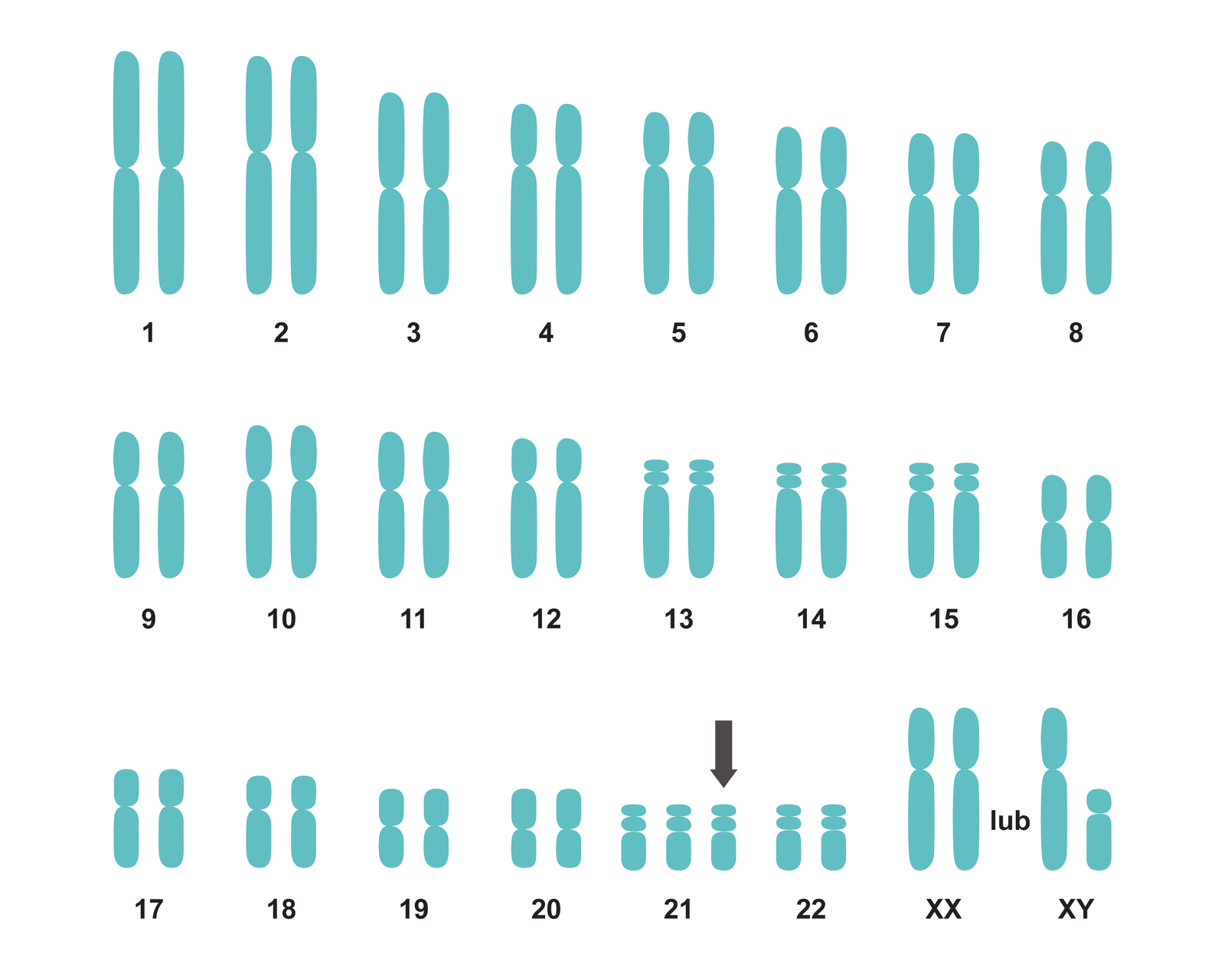 Ilustracja przedstawia kariotyp osoby z zespołem Downa. Wśród 23 par chromosomów homologicznych, przy dwudziestej pierwszej parze znajduje się jeden, dodatkowy chromosom. 