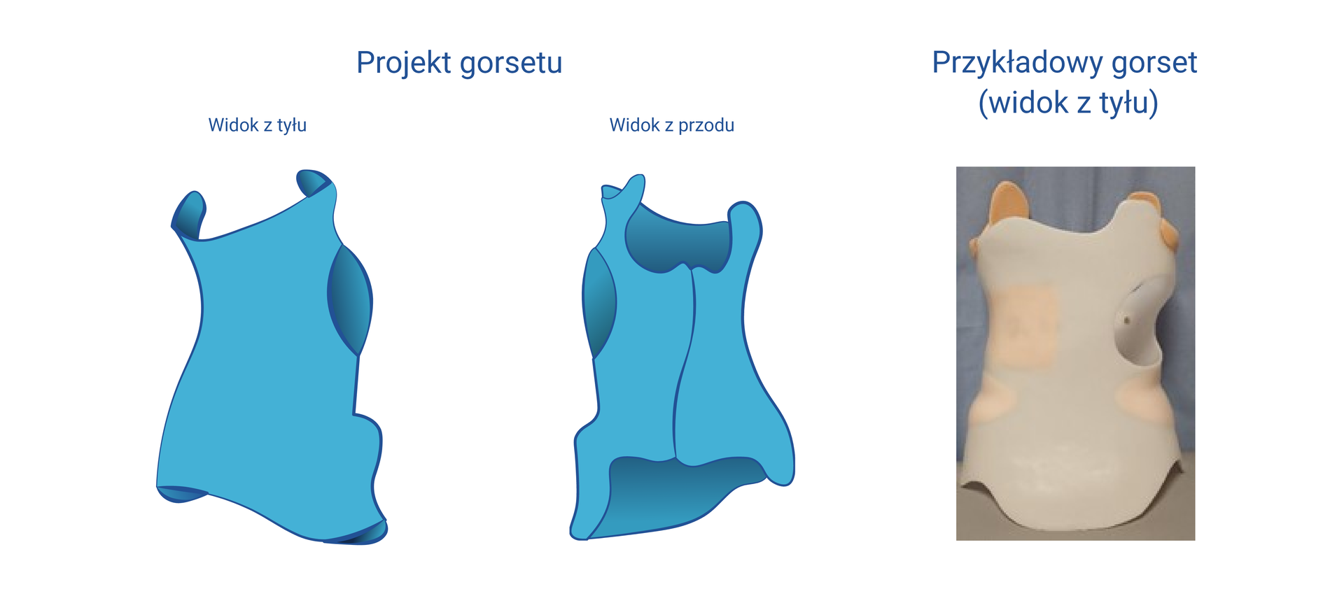 Grafika przedstawiająca schemat gorsetu z przodu i z tyłu. Gorset obejmuje większość tułowia. Na rycinie zamieszczono również zdjęcie przykładowego gorsetu z tworzywa sztucznego w widoku z tyłu.
