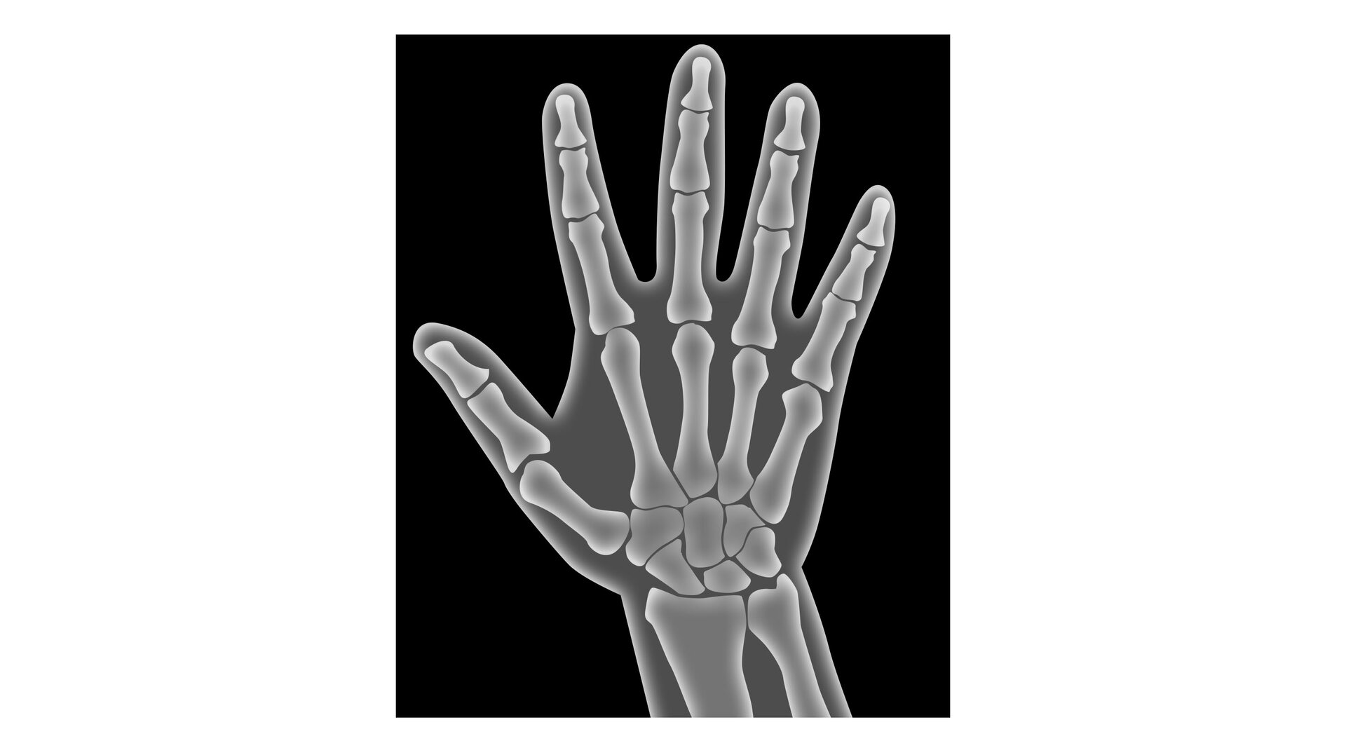 
Ilustracja ukazuje rentgenowskie zdjęcie ręki.