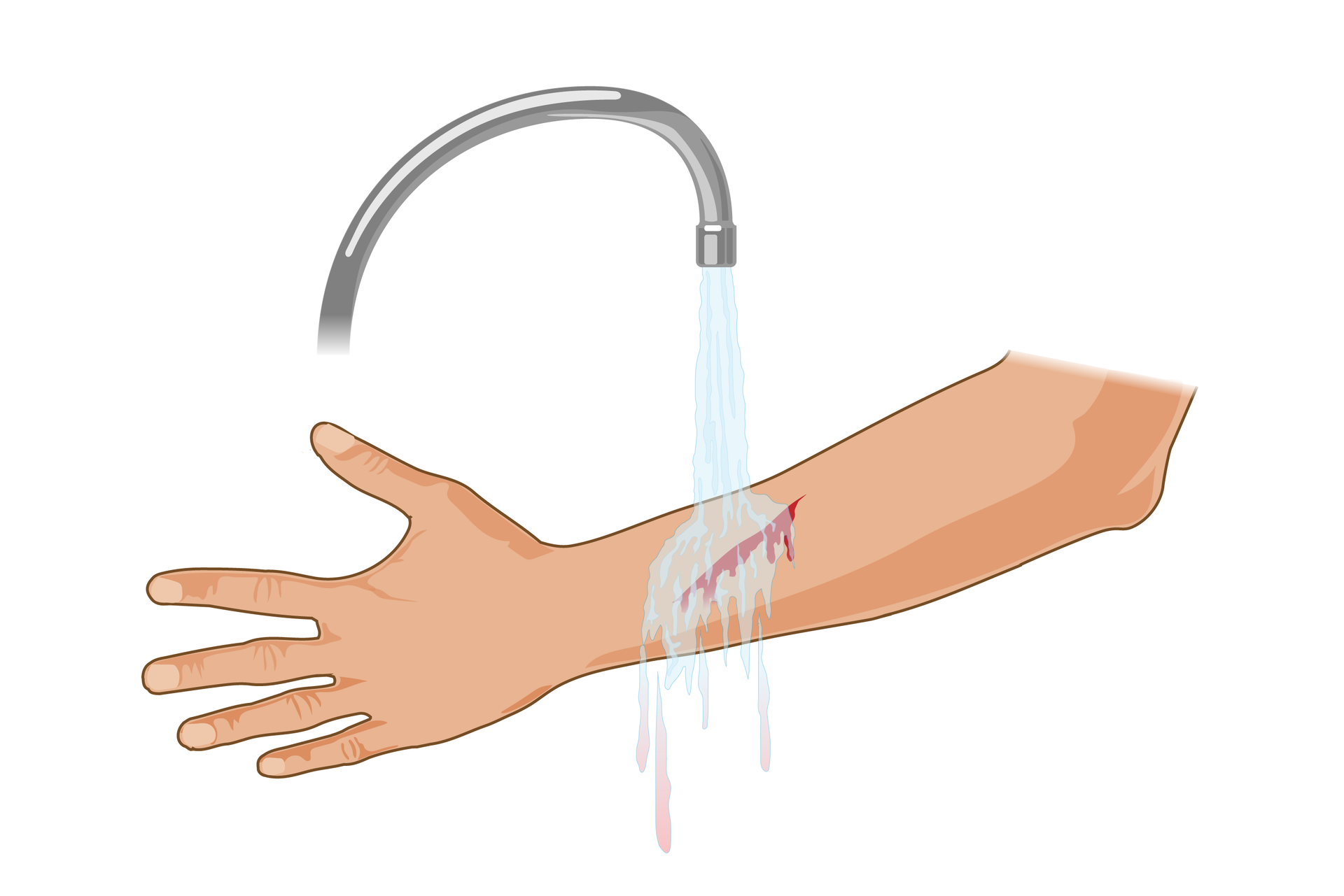 Ilustracja przedstawia przemywanie rany. Lewa ręka ukazana od dłoni z wyprostowanymi palcami po lewej stronie rysunku do łokcia po prawej stronie skierowana jest zewnętrzną stroną do obserwatora. Mniej więcej w połowie przedramienia kilkucentymetrowa krwawiąca rana cięta. Powyżej kran z odkręconą wodą. Strumień obmywa ranę spłukując krew.