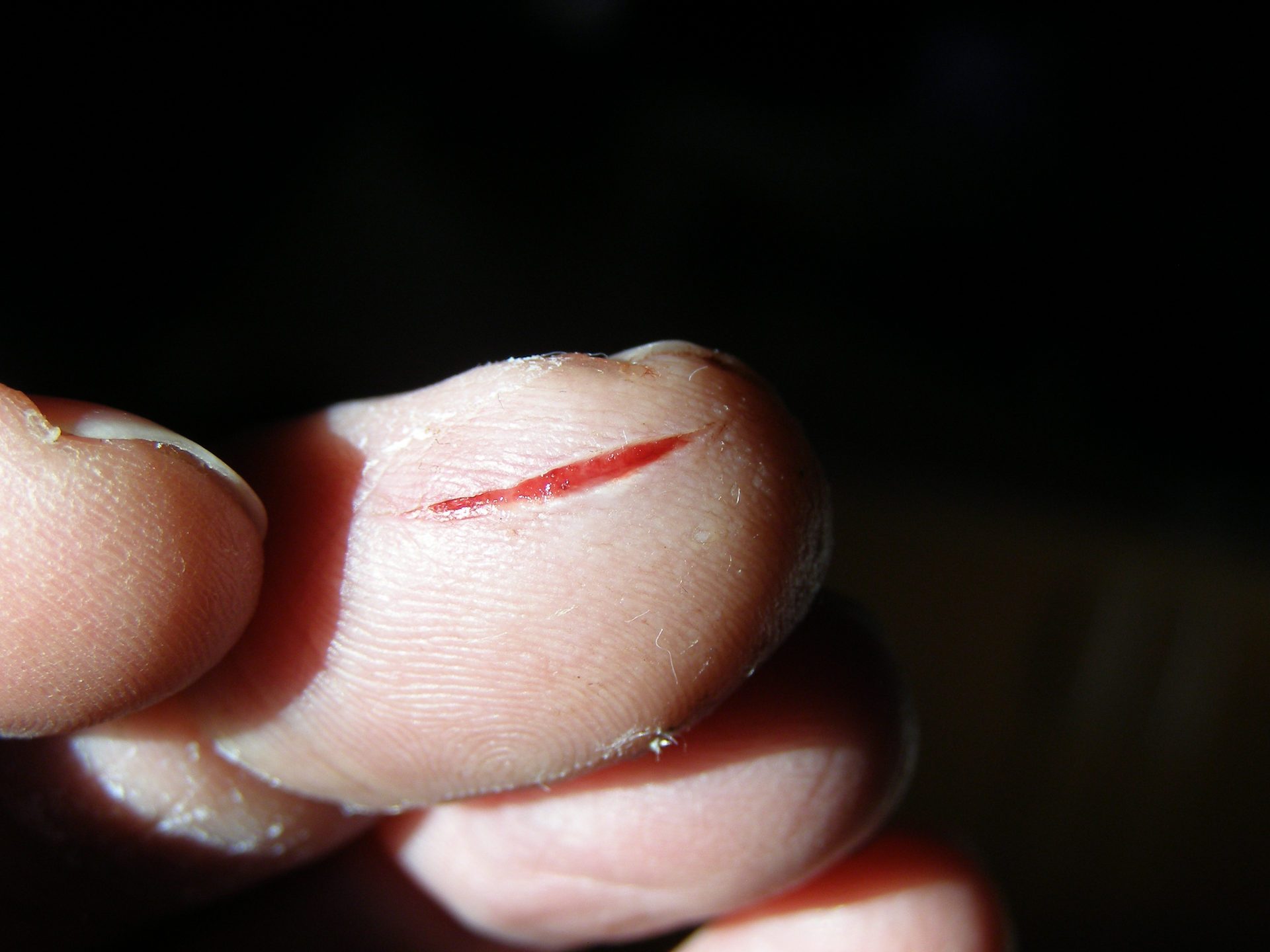Fotografia niewielkiej rany na palcu.