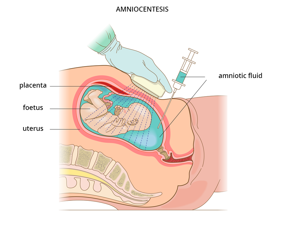 Ilustracja przedstawia pobieranie płynu owodniowego (Amniocentesis) przez brzuszną powłokę ciała. Na ilustracji widoczna jest ręka lekarza, który przykłada głowicę USG do brzucha matki, badając położenie płodu (foetus). Pobieranie płynu owodniowego (amniotic fluid) odbywa się poprzez wbicie igły do macicy (uterus) i pobranie do strzykawki płyny owodniowego, tak by nie uszkodzić płodu. Na ilustracji widoczne jest również łożysko (placenta) z którym płód połączony jest pępowiną.