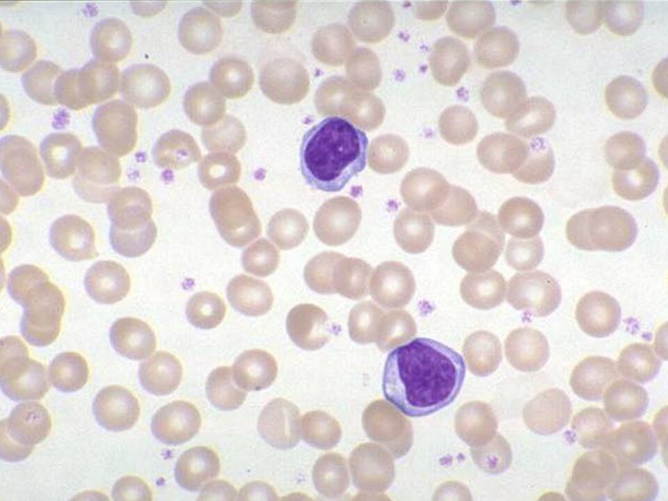 Na fotografii z mikroskopu świetlnego w powiększeniu tysiąckrotnym znajdują się limfocyty w formie fioletowych punktów, które nie mają ziarnistości w cytozolu, a ich jądra komórkowe są zaokrąglone lub mają nerkowaty kształt. 