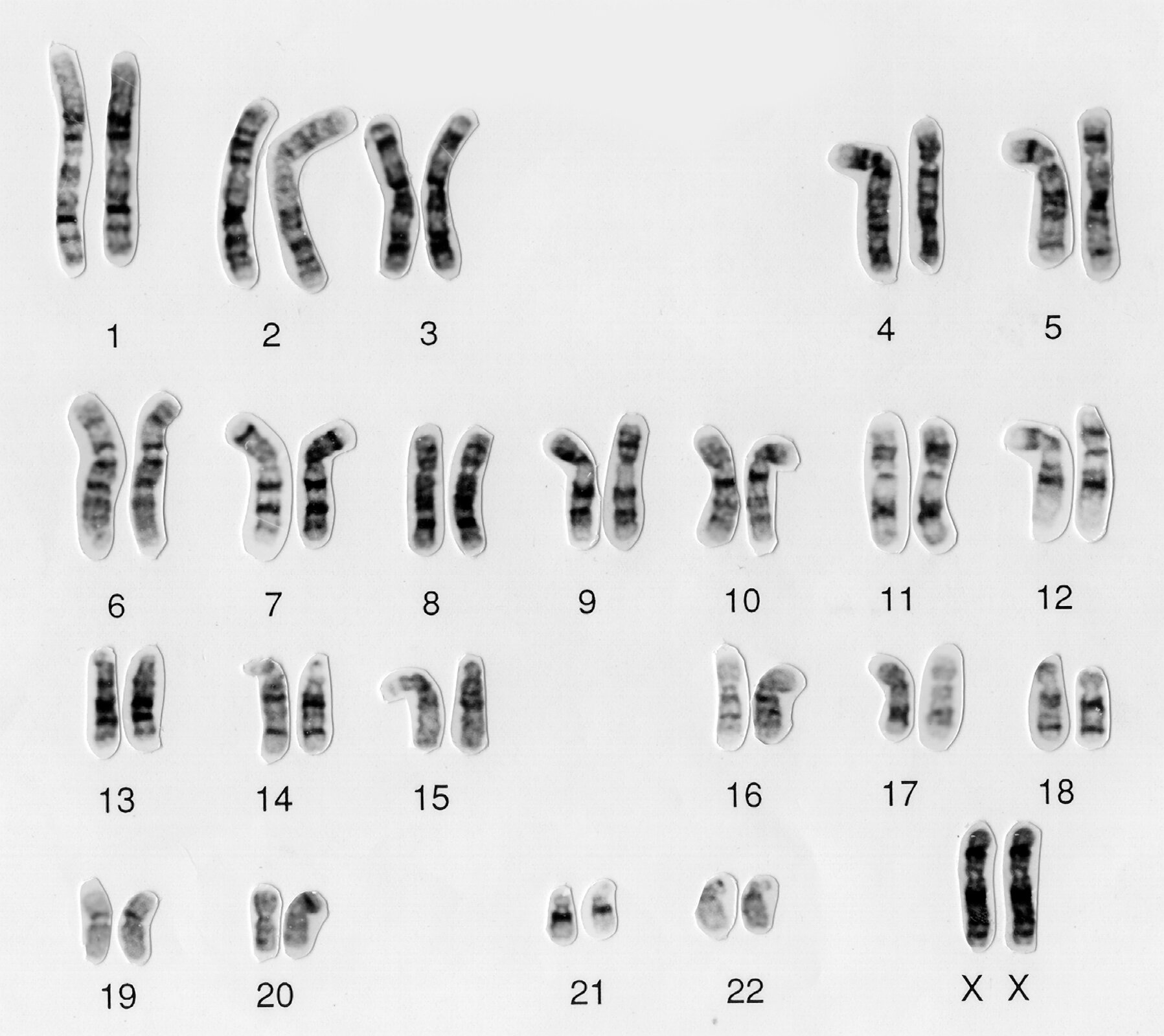 Grafika przedstawia dwadzieścia trzy pary chromosomów kobiety, w tym jedną parę chromosomów płci X oraz X. Chromosomy mają pałeczkowaty kształt - przypominają dłuższe lub krótsze wałeczki. Niektóre z nich są odgięte do boku. Każdy z nich jest poprzecznie prążkowany. Układ i kolor prążków jest podobny w każdej parze chromosomów. Chromosomy w poszczególnych parach są też do siebie podobne rozmiarem oraz kształtem. Pierwsza para jest najdłuższa, następnie każda kolejna para jest krótsza, aż do pary dwudziestej drugiej. Chromosomy płci, stanowiące ostatnią parę, są podobnej długości, co chromosomy od ósmej do dwunastej pary.