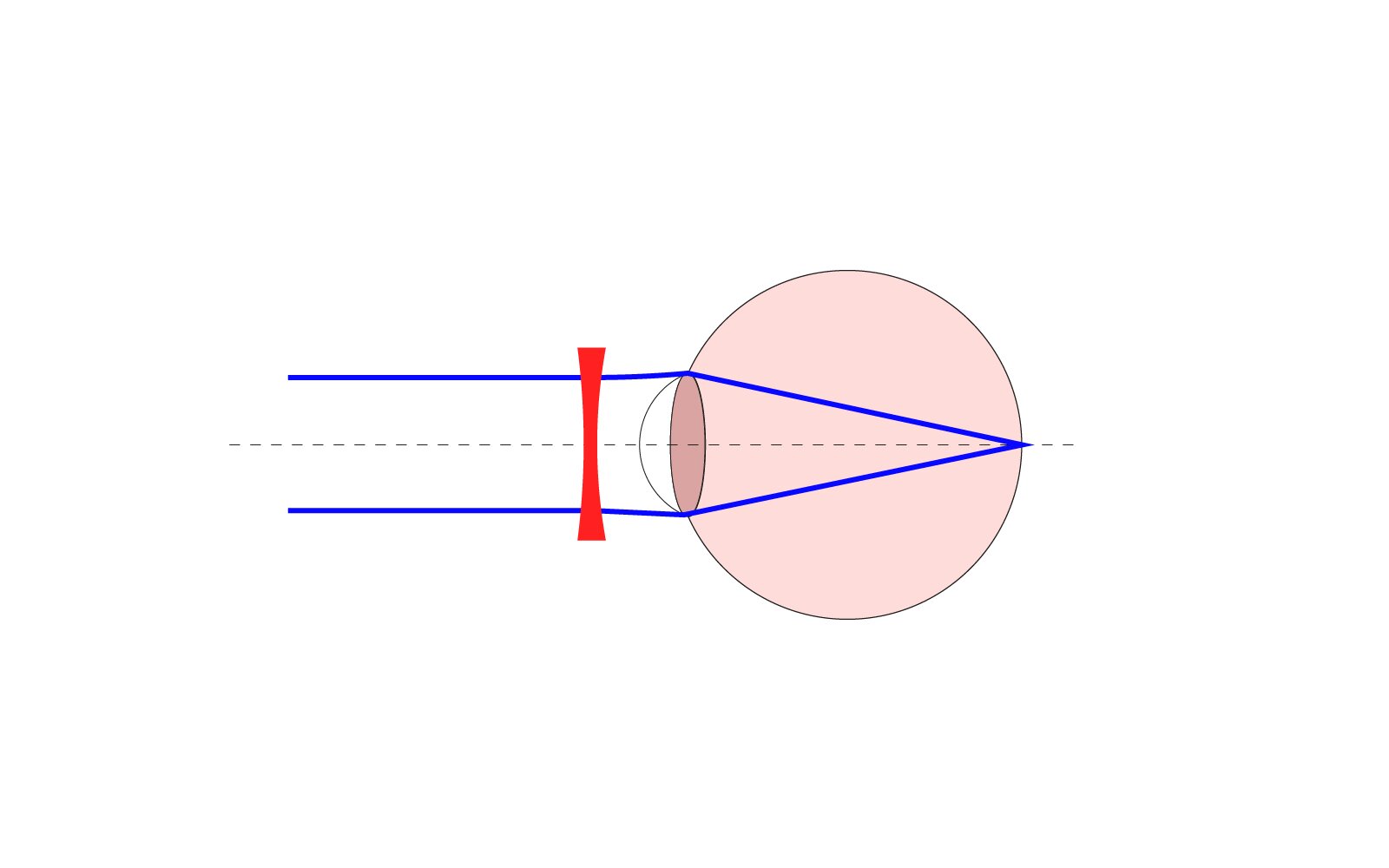 Ilustracja przedstawia krótkowzroczność oka pokazane jest oko oraz nieprawidłowe ogniskowanie światła na siatkówce oka. Za siatkówką promienie świetlne załamują się,