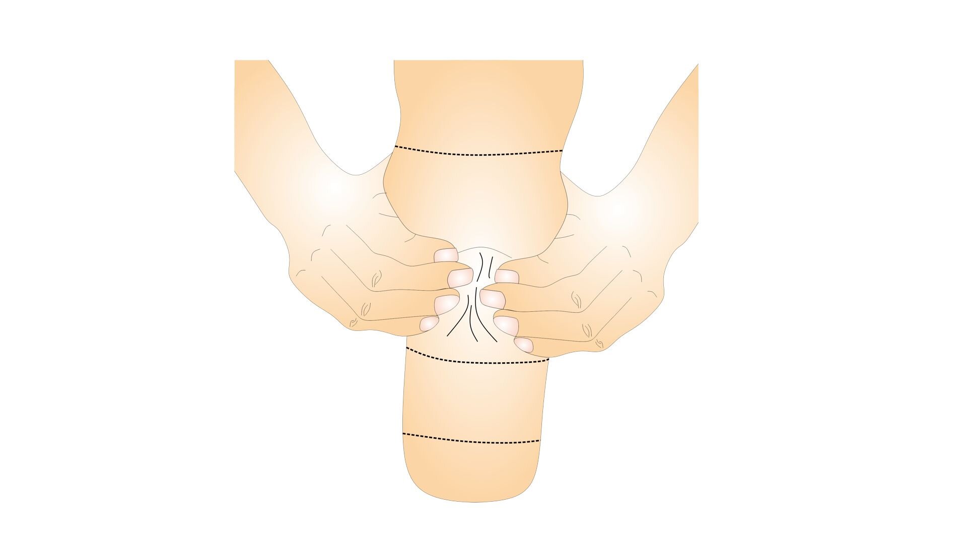 Rycina przedstawia kończynę dolną po amputacji na wysokości połowy łydki. Na grafice zaprezentowane są dłonie, które uciskają dół podkolanowy. Kciuki znajdują się z tyłu kończyny pacjenta, a pozostałe palce uciskają pod stawem kolanowym.