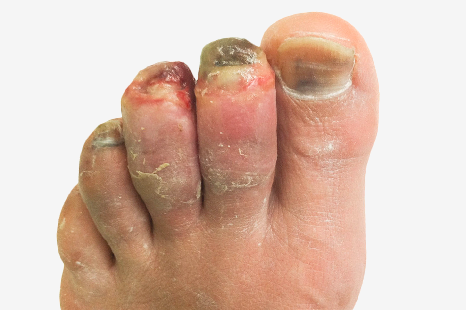 Zdjęcie po prawej to palce stóp z odmrożeniem III stopnia. Palce stopy pokryte są fioletową skórą na całej długości. Palce są opuchnięte. Paznokcie czarne. Okolice wokół paznokci pokryte krwią. Paznokieć dużego palca pokryty jest czarnymi plamami.