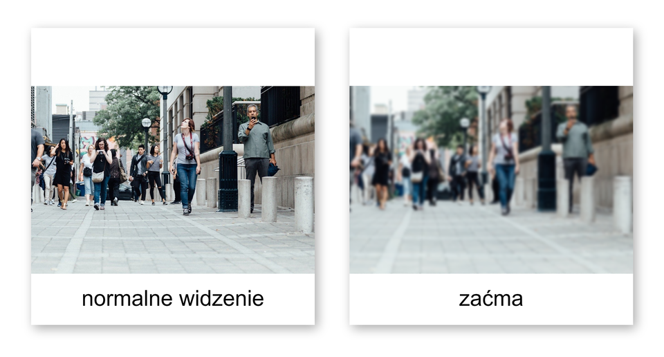 Dwa zdjęcia. Ukazują ludzi idących chodnikiem w mieście. Pierwszy obraz jest wyraźny. To normalne widzenie. Drugie zdjęcie jest zamglone. To widzenie osoby chorującej na zaćmę.    