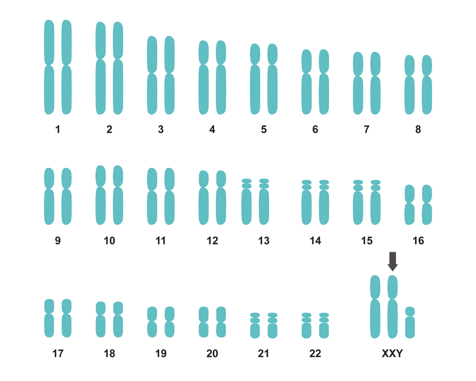 Ilustracja przedstawia kariotyp osoby z zespołem Klinefeltera. Na ilustracji 22 pary chromosomów różnej wielkości. W ostatniej, 23 parze prawidłowo powinny występować chromosomy XX (żeńskie) oraz XY (żeński i męski), które warunkują płeć. W tym przypadku występują dwa chromosomy X i jeden chromosom Y. 