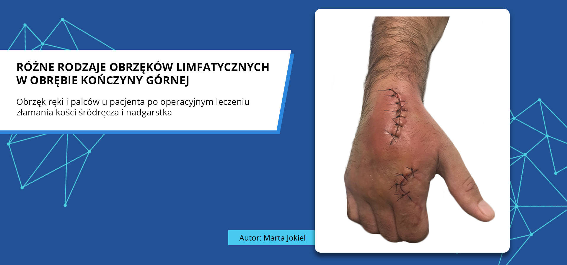 Zdjęcie o tytule różne rodzaje obrzęków limfatycznych w obrębie kończyny górnej. Obrzęk ręki i palców u pacjenta po operacyjnym leczeniu złamania kości śródręcza i nadgarstka. Zdjęcie przedstawia dłoń z zaszytymi ranami w okolicy nadgarstka i palca wskazującego. Autorka zdjęcia: Marta Jokiel.