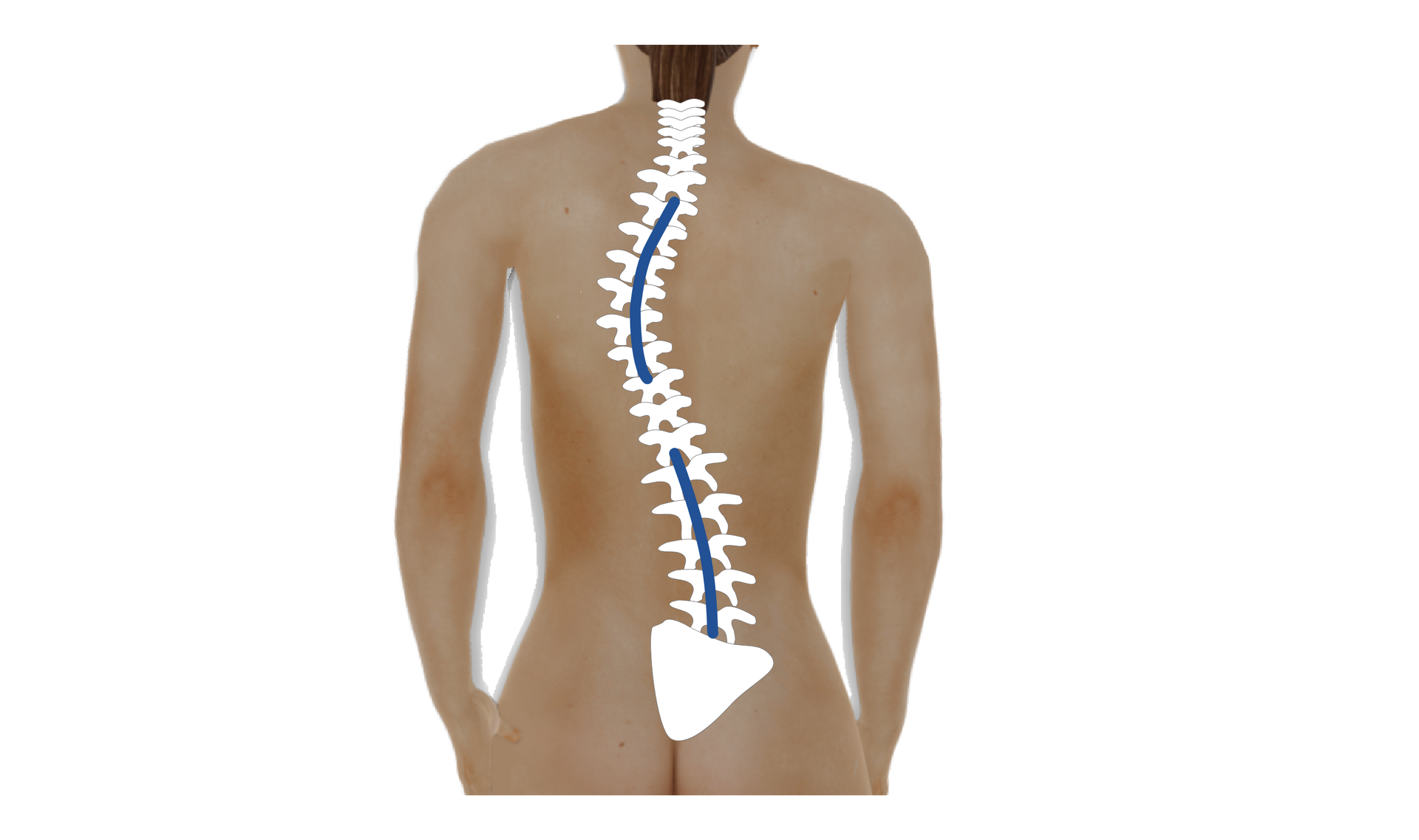 Grafika przedstawiająca ciało człowieka. Na rycinie zaznaczono kręgosłup ze skrzywieniem w odcinku piersiowym i lędźwiowym.
