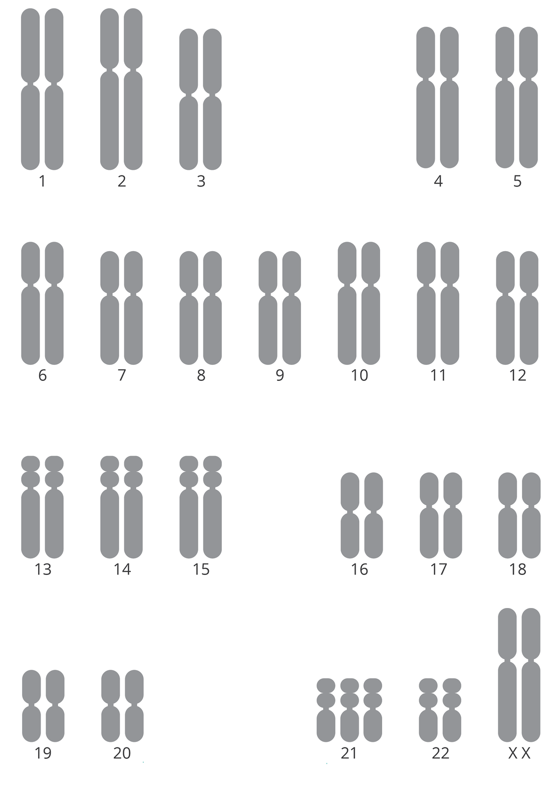 Kariotyp przedstawia 47 chromosomów, z czego dwa to chromosomy płciowe X i X. Pozostałe to autosomy. W parze 21 występuje dodatkowy chromosom.
