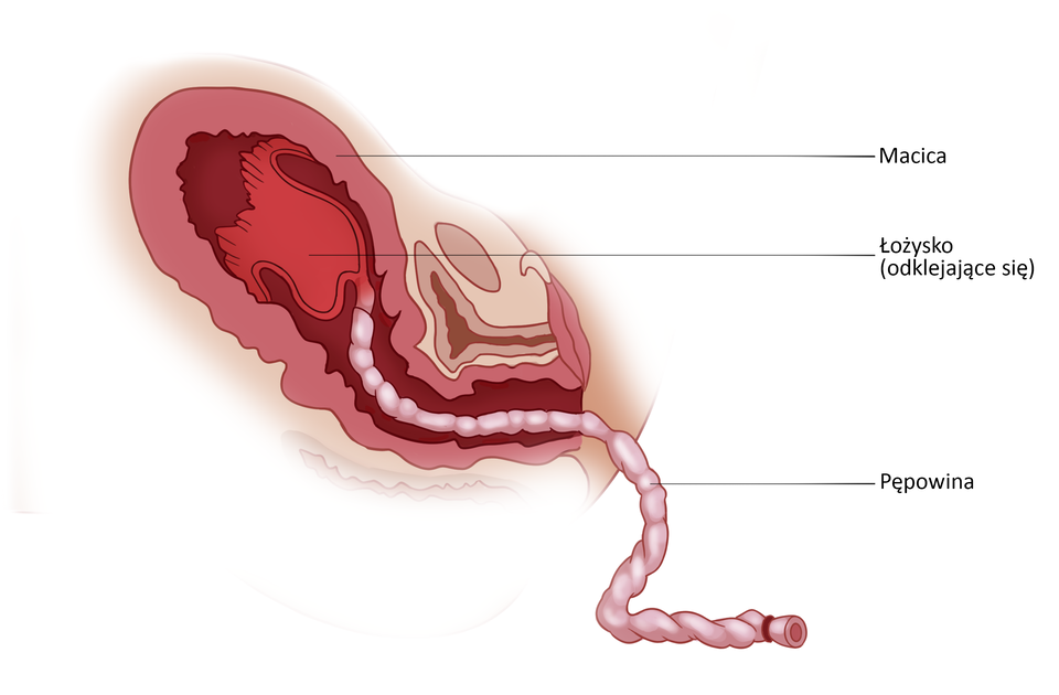 Ilustracja przedstawia macicę po porodzie. Łożysko odkleja się od macicy i wraz z pępowiną zostaje wydalone. 