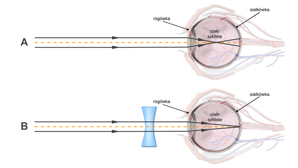 Ilustracja przedstawia dwie gałki oczne, na których pokazano wadę krótkowzroczności. Zaznaczono przednią część oka - rogówkę, ciało szkliste - substancję wypełniającą tylną część gałki ocznej, oraz siatkówkę. W oku krótkowzrocznym równoległe promienie świetne ogniskowane są przed siatkówką. Po korekcji przez soczewkę wklęsłą okularów skupiają się prawidłowo - na siatkówce. 