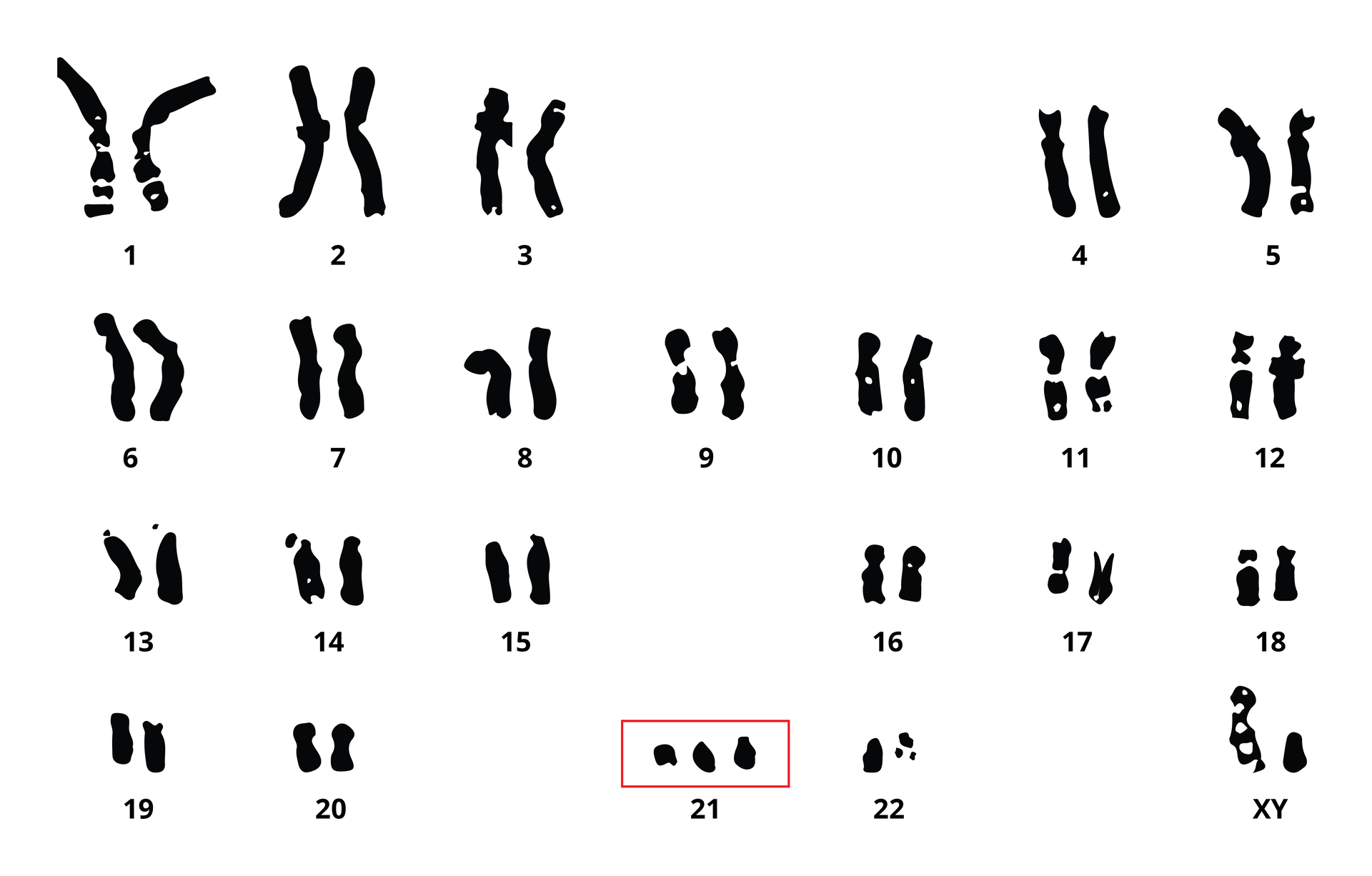 Ilustracja przestawia czarne pary chromosomów na białym tle. Mają różny kształt i różną wielkość. Każda para ma swój numer. Para numer 21 jest zaznaczona czerwoną ramką. Znajdują się tu 3 chromosomy, zamiast dwóch. Skutki takiej mutacji chromosomowej zwane są zespołem Downa.