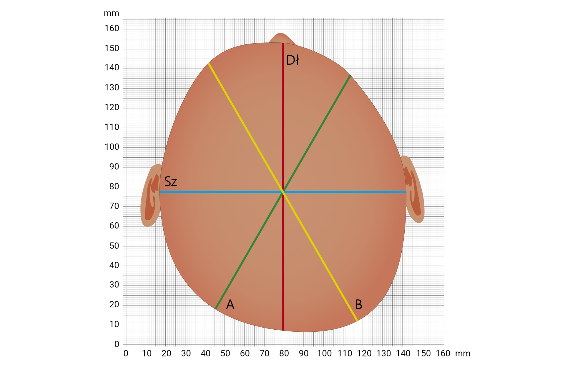 Grafika przedstawiająca przykładową czaszkę dziecka z plagiocefalią. Na zamieszczonym na siatce milimetrowej schemacie zaznaczono odległości: skośną krótszą, skośną dłuższą, szerokość i długość. 

