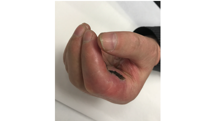 Cechy charakterystyczne obrzęku limfatycznego