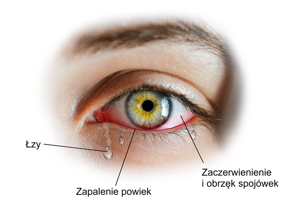 Ilustracja przedstawia ludzkie oko. Z oka spływają łzy. W dolnej części oka i w kąciku okaz jest zaczerwienienie. To zapalenie powiek. Widoczne są zaczerwienienie i obrzęk spojówek. 