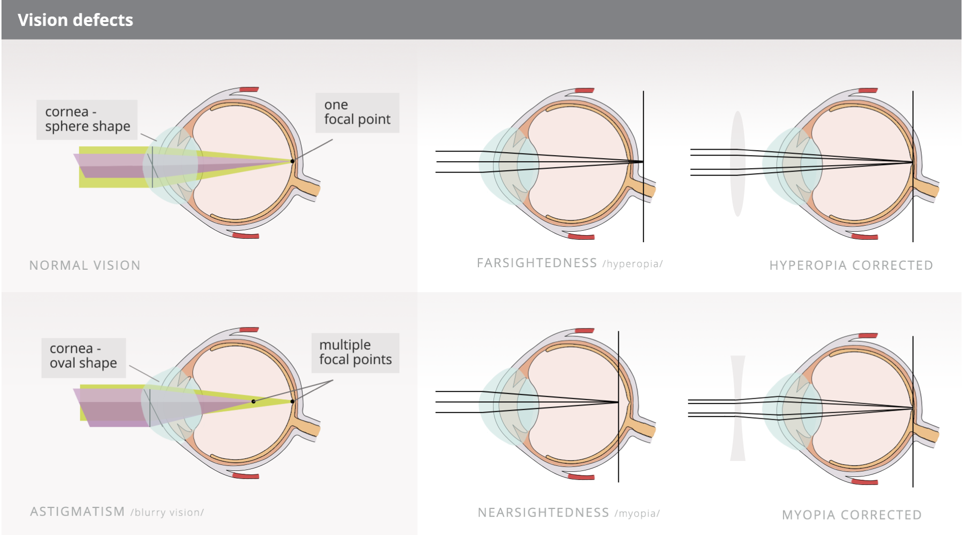 Rysunek zatytułowany Vision defects prezentuje różne wady wzroku i metody ich korekcji. Na górze po lewej schemat opisany normal vision: gałka oczna i padające promienie zbiegające się w jednym punkcie opisanym one focal point. Zaznaczo rogówkę opisaną cornea - sphere shape. Na dole po lewej schemat opisany astigmatism, blurry  vision: gałka oczna i padające promienie zbiegające się w dwóch punktach opisanych multiple focal points. Zaznaczo rogówkę opisaną cornea - oval shape. Na górze po prawej schemat opisany farsightedness, hyperopia: gałka oczna i padające promienie zbiegające się w jednym punkcie za gałką oczną. Obok schemat opisany hyperopia corrected: gałka oczna i padające promienie na soczewkę wypukłą znajdującą się przed gałką, promienie zbiegają się w jednym punkcie na końcu gałki ocznej. Na dole po prawej schemat opisany nearsightedness, myopia: gałka oczna i padające promienie zbiegające się w jednym punkcie wewnątrz gałki ocznej. Obok schemat opisany myopia corrected: gałka oczna i padające promienie na soczewkę wklęsłą znajdującą się przed gałką, promienie zbiegają się w jednym punkcie na końcu gałki ocznej.