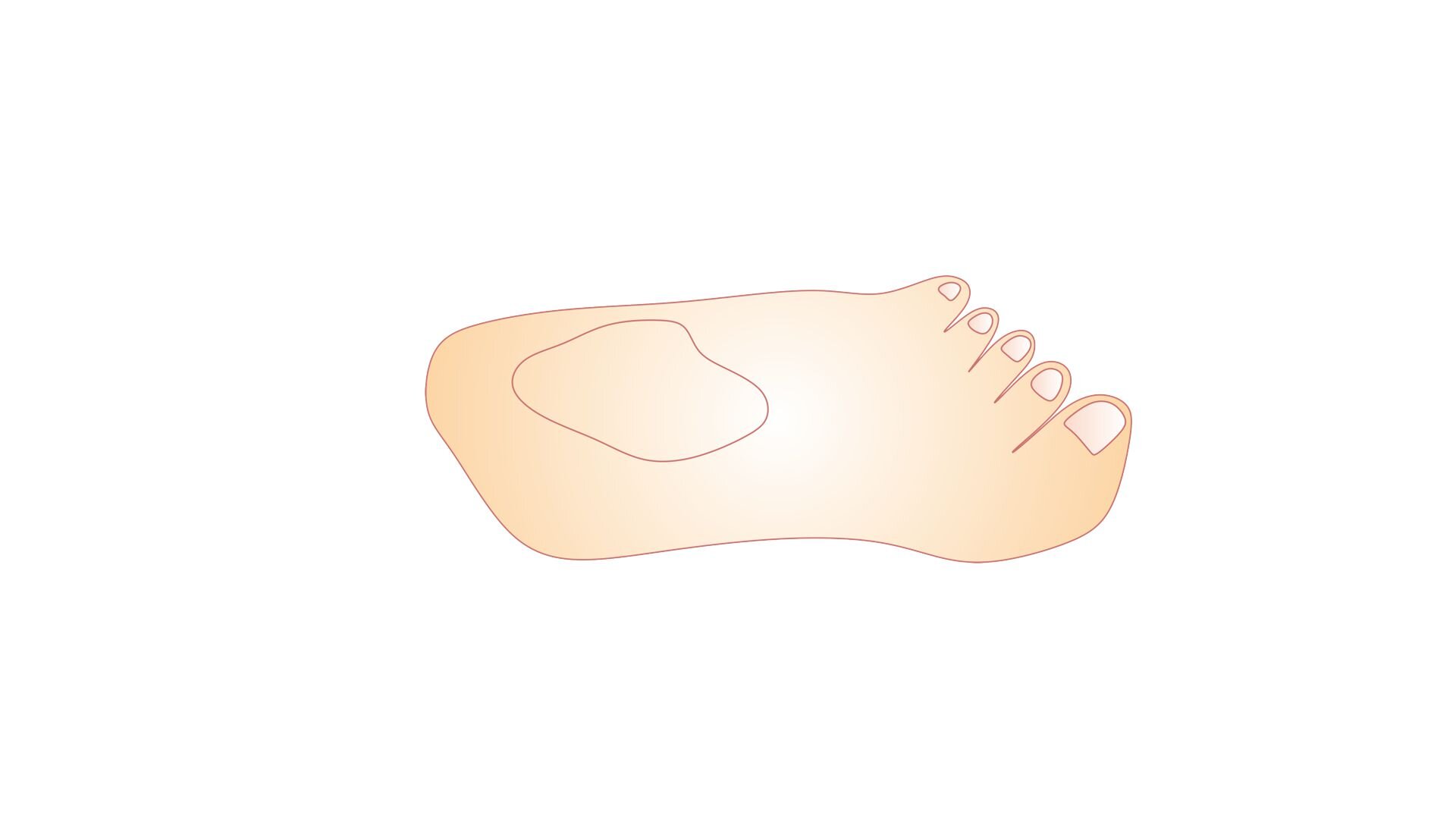 Grafika przedstawia schemat formy obuwniczej gipsowej w widoku z góry, wykonanej w oparciu o stopę zniekształconą w stopniu znacznym.