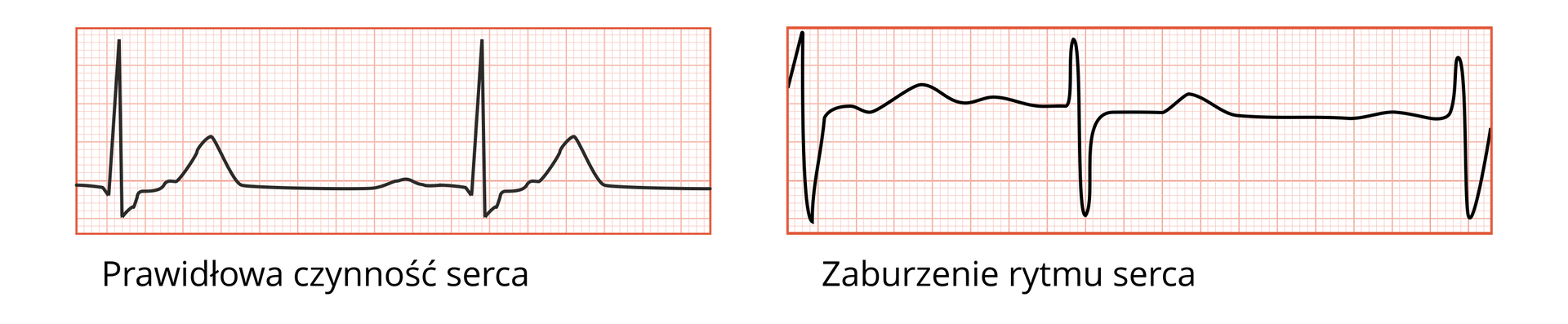 Ilustracja przedstawia dwa odczyty czynności serca. Z lewej strony znajduje się prawidłowy odczyt rytmu serca, jest on okresowy, czyli powtarza się co jakiś okres. Po prawej stronie znajduje się odczyt zaburzonego rytmu serca, jest on nieregularny.
