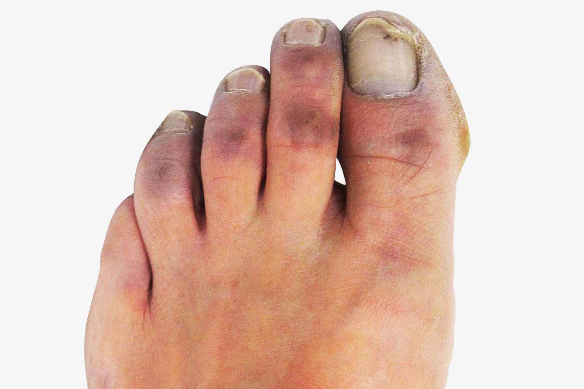 Kliknij żeby powiększyć Galeria 1 składa się z dwóch zdjęć. Zdjęcie u góry przedstawia palce stóp z głębokim odmrożeniem II stopnia. Górna część wszystkich palców jest pokryta fioletową skórą. Paznokcie są szare.