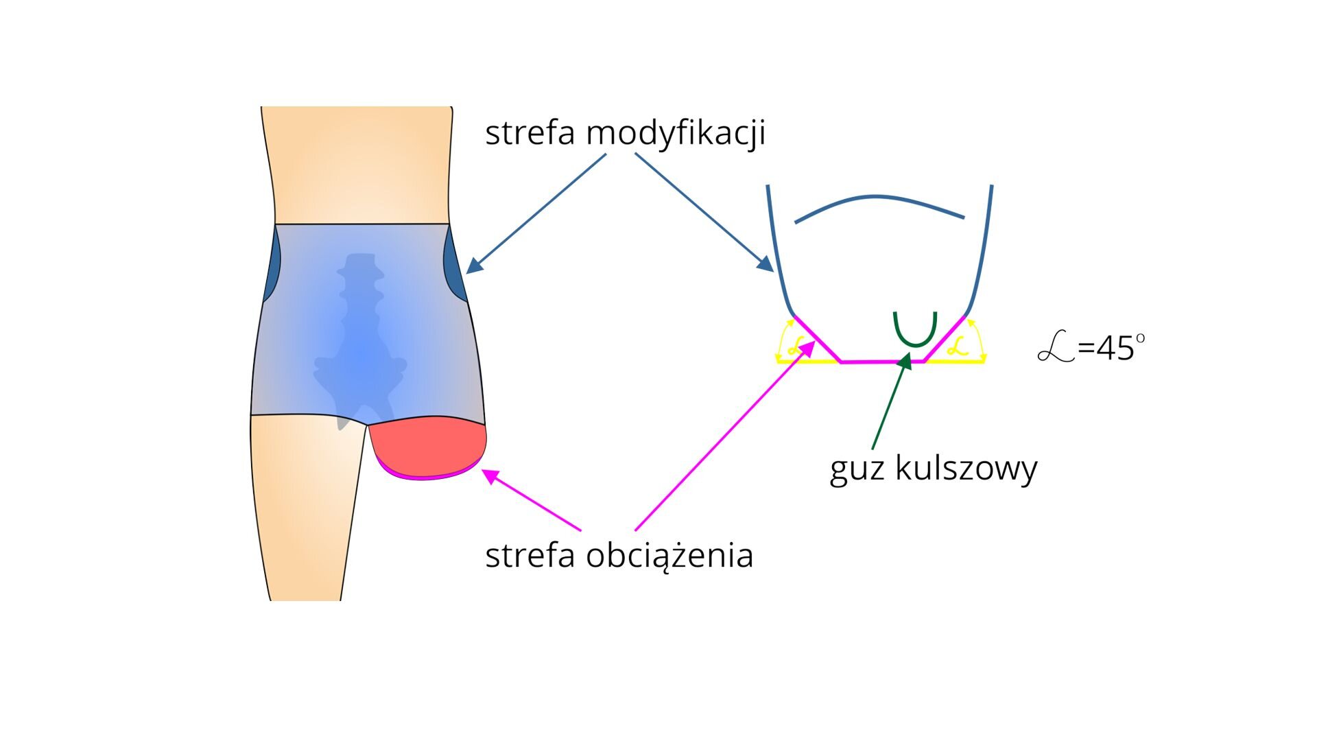 Rycina przedstawia schemat strefy modyfikacji w metodzie tradycyjnej. Strefa modyfikacji znajduje się w okolicy bioder pacjenta, a strefa obciążenia – na końcu kikuta, z zagięciami kosza o kącie 45 stopni w okolicach guza kulszowego i symetrycznie po drugiej stronie kosza.
