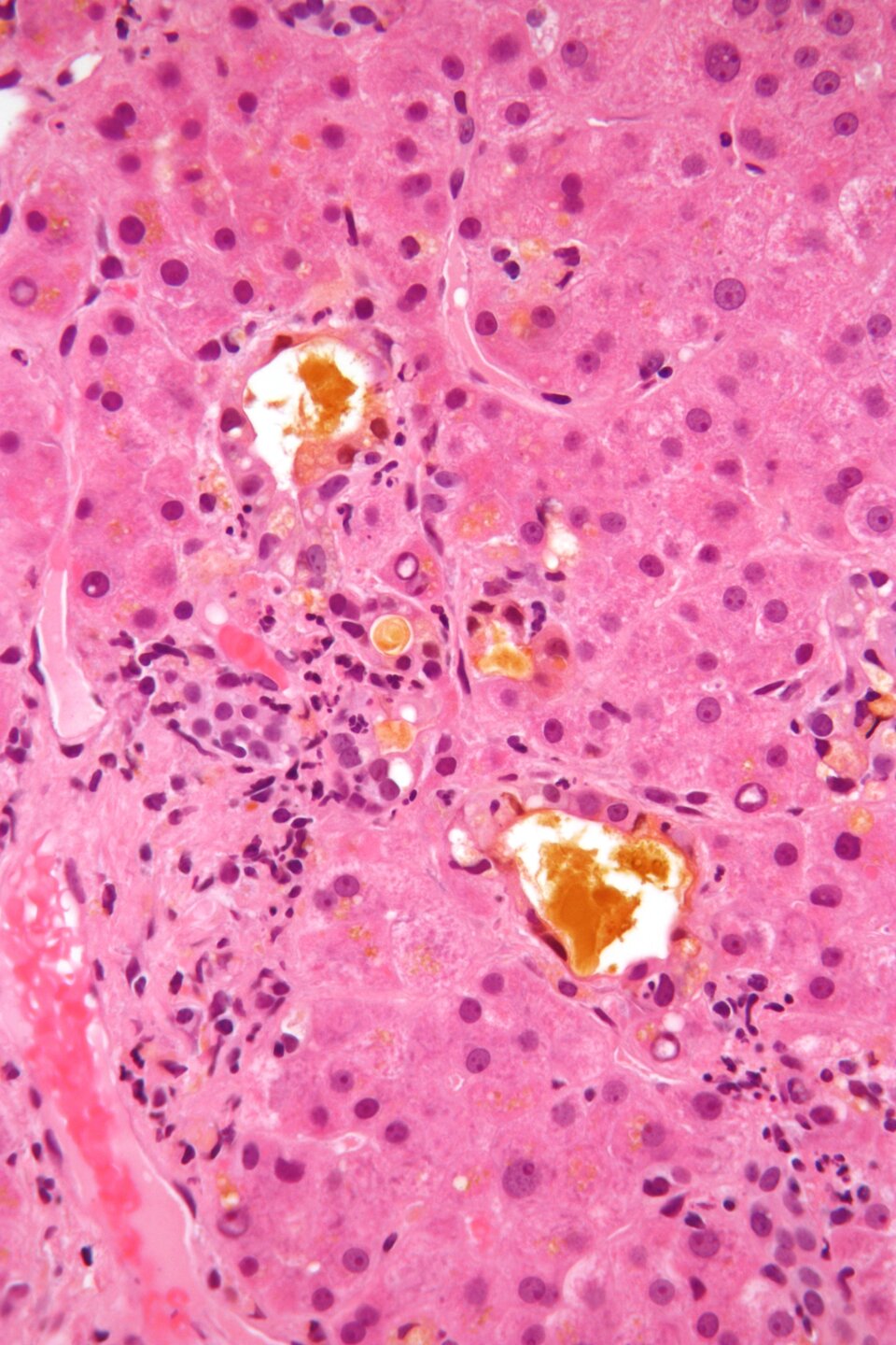 Grafika przedstawia preparat histologiczny w czterystukrotnym powiększeniu mikroskopu. Pośród jasnoróżowej masy komórkowej z ciemniejszymi kulistymi plamkami oznaczającymi jądro komórkowe widoczne są żółte krople o nieregularnym kształcie i rozmieszczeniu. 