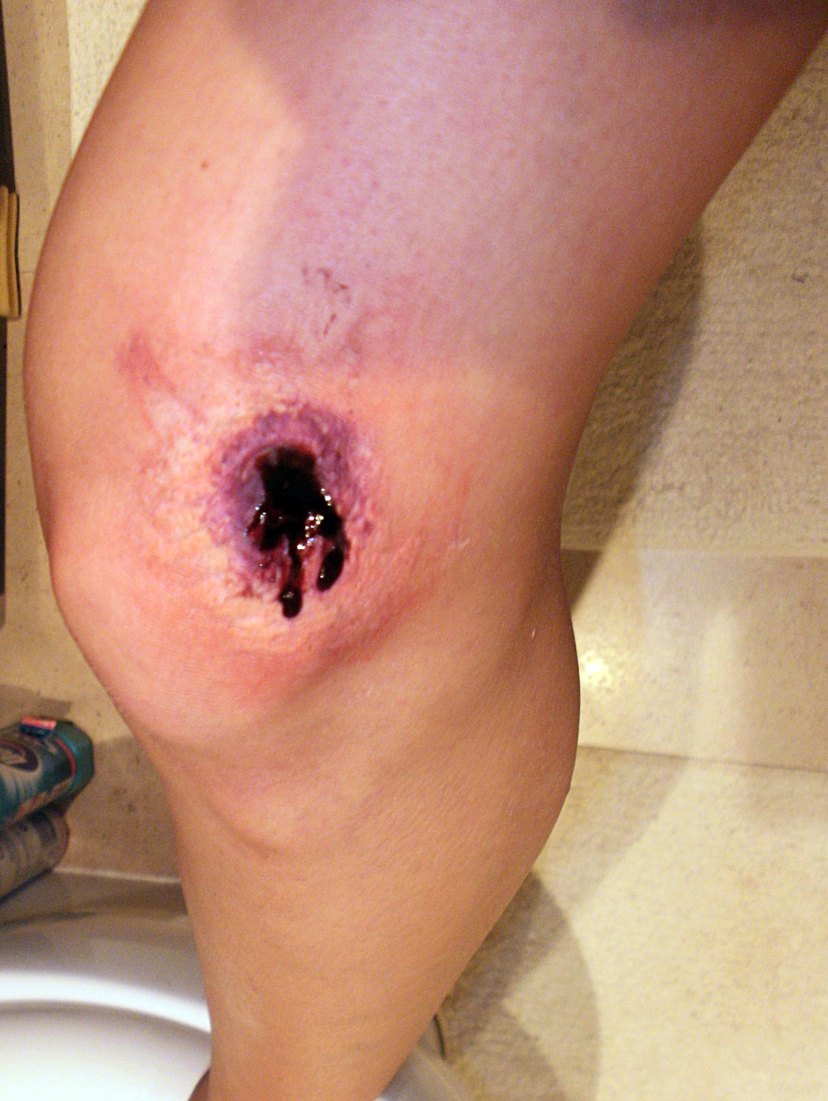 Zdjęcie numer cztery przedstawia ranę postrzałową. Zbliżenie na kolano prawej nogi poszkodowanego. Na wewnętrznej stronie nogi, powyżej kolana, fioletowa owalna dziura po kuli średnicy około 3 centymetrów. Z rany sączy się powoli ciemna krew. Na kolanie widoczny obrzęk.