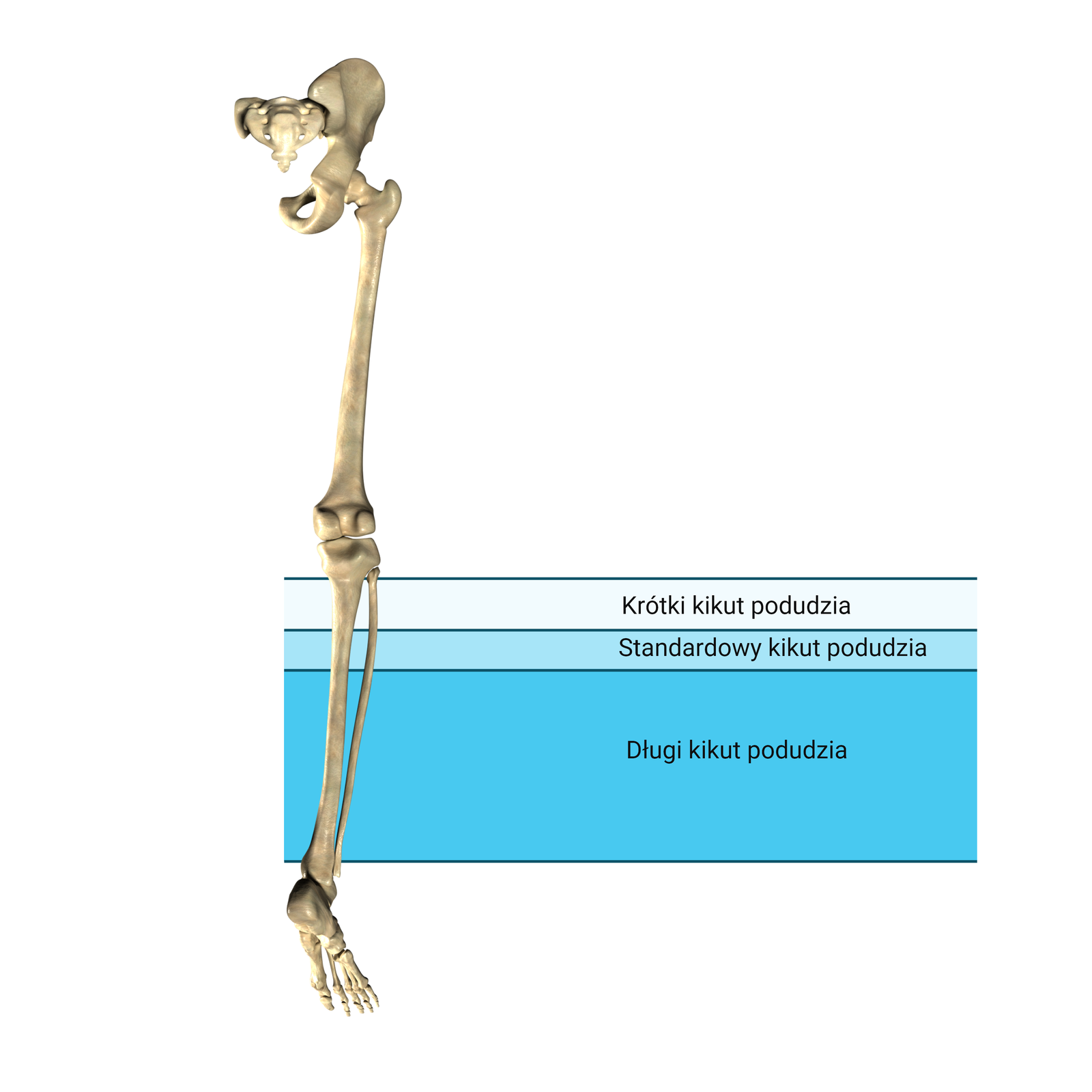 Grafika przedstawia szkielet kończyny dolnej. Na rycinie zaznaczono długości kikutów po amputacji na poziomie podudzia. Krótki kikut podudzia powstaje po amputacji poniżej stawu kolanowego. Standardowy kikut podudzia występuje po amputacji w bliższej jednej trzeciej podudzia. Długi kikut podudzia powstaje po amputacji w dalszych dwóch trzecich podudzia.