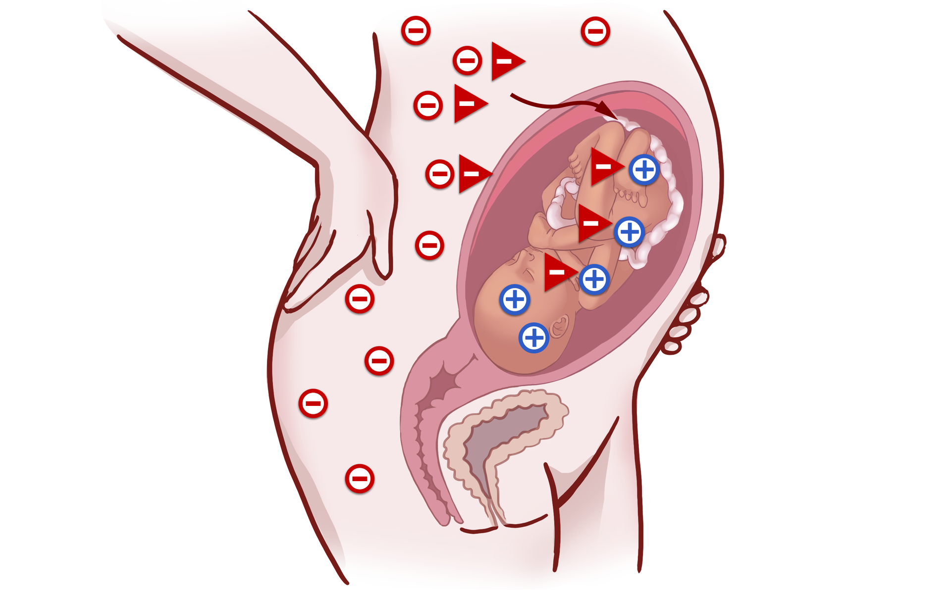Grafika przedstawia przekrój ciała kobietę w ciąży. Na jej ciele widoczne są minusy, sygnalizujące grupę krwi Rh-. Natomiast płód posiada grupę krwi Rh+, sygnalizowaną przez plusy na jego ciele. Dochodzi do kontaktu krwi matki z krwią płodu, co powoduje wytworzenie we krwi matki przeciwciał anty‑D. Przeciwciała te łączą się z erytocytami płodu, przez co dochodzi do aglutynacji krwi.
